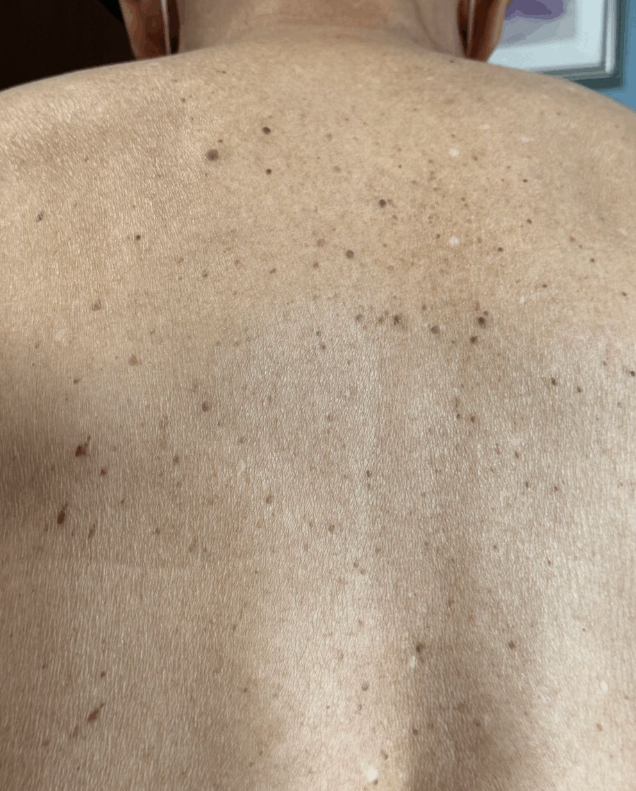 QUERATOSIS SEBORREICA