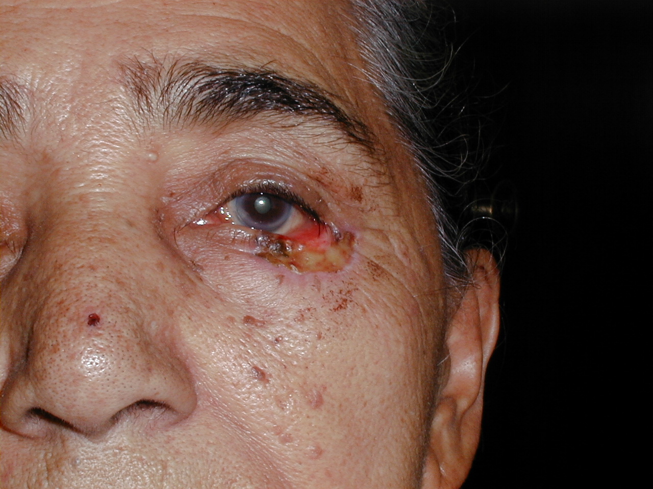 CARCINOMA BASOCELULAR
