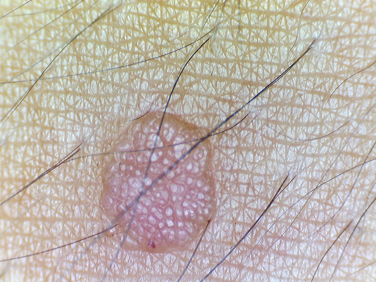 VERRUGA VULGAR - Dermatoscopía