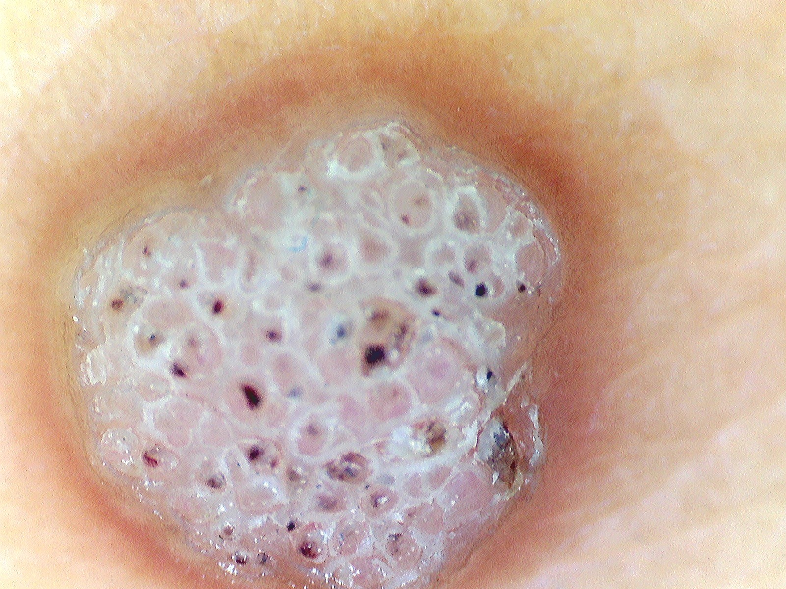 VERRUGA VULGAR - Dermatoscopía