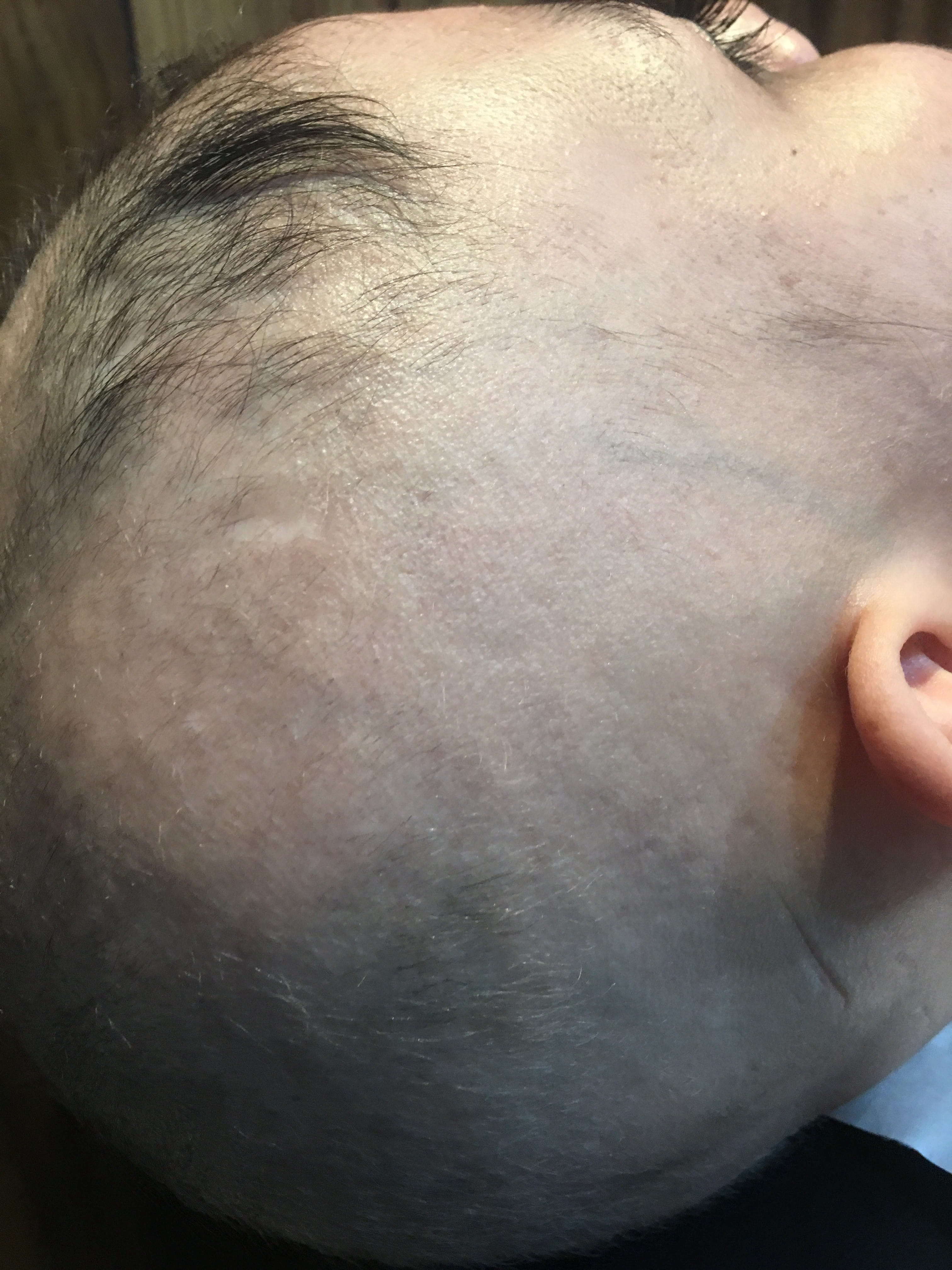 ALOPECIA AREATA
