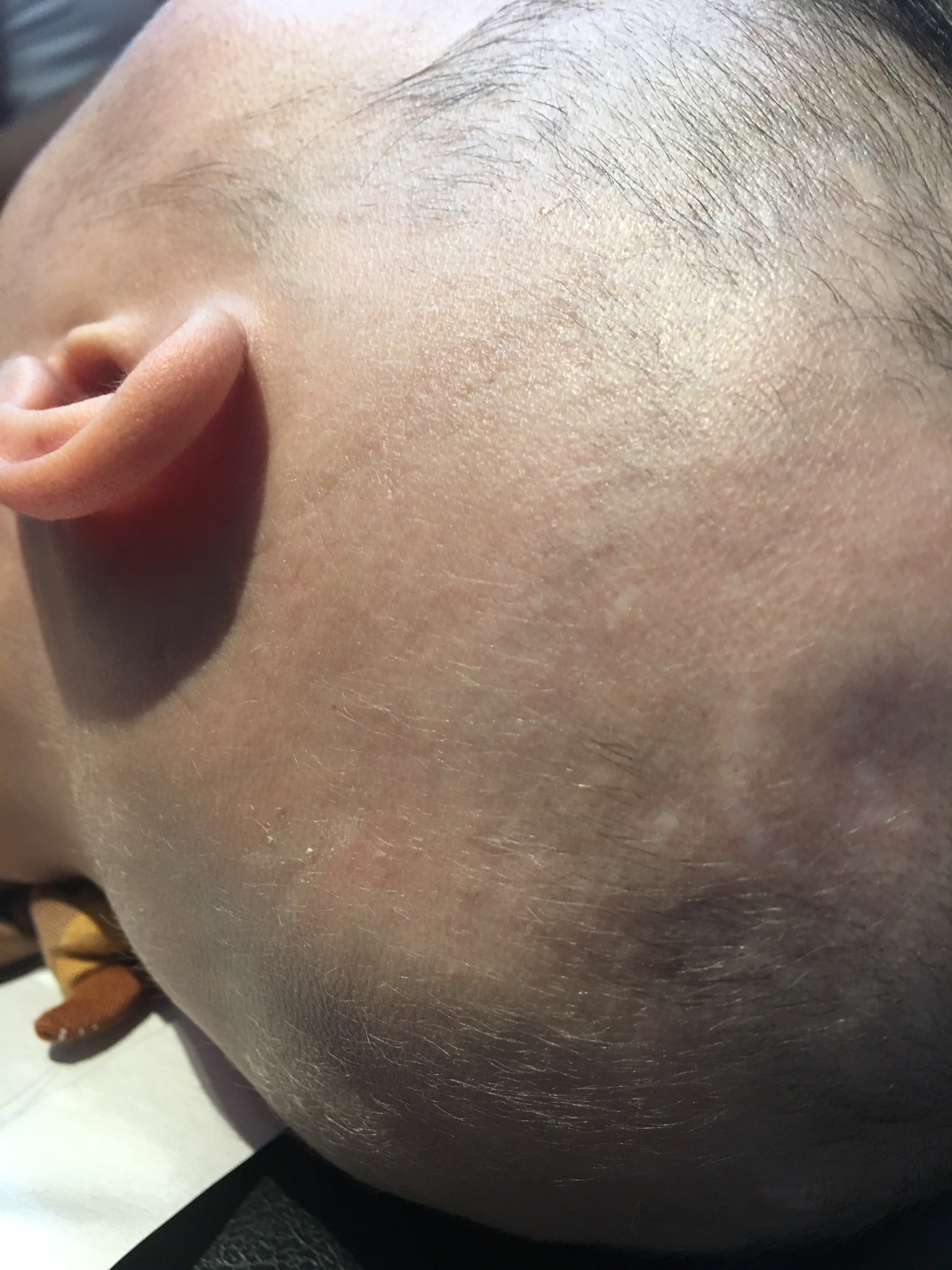ALOPECIA AREATA