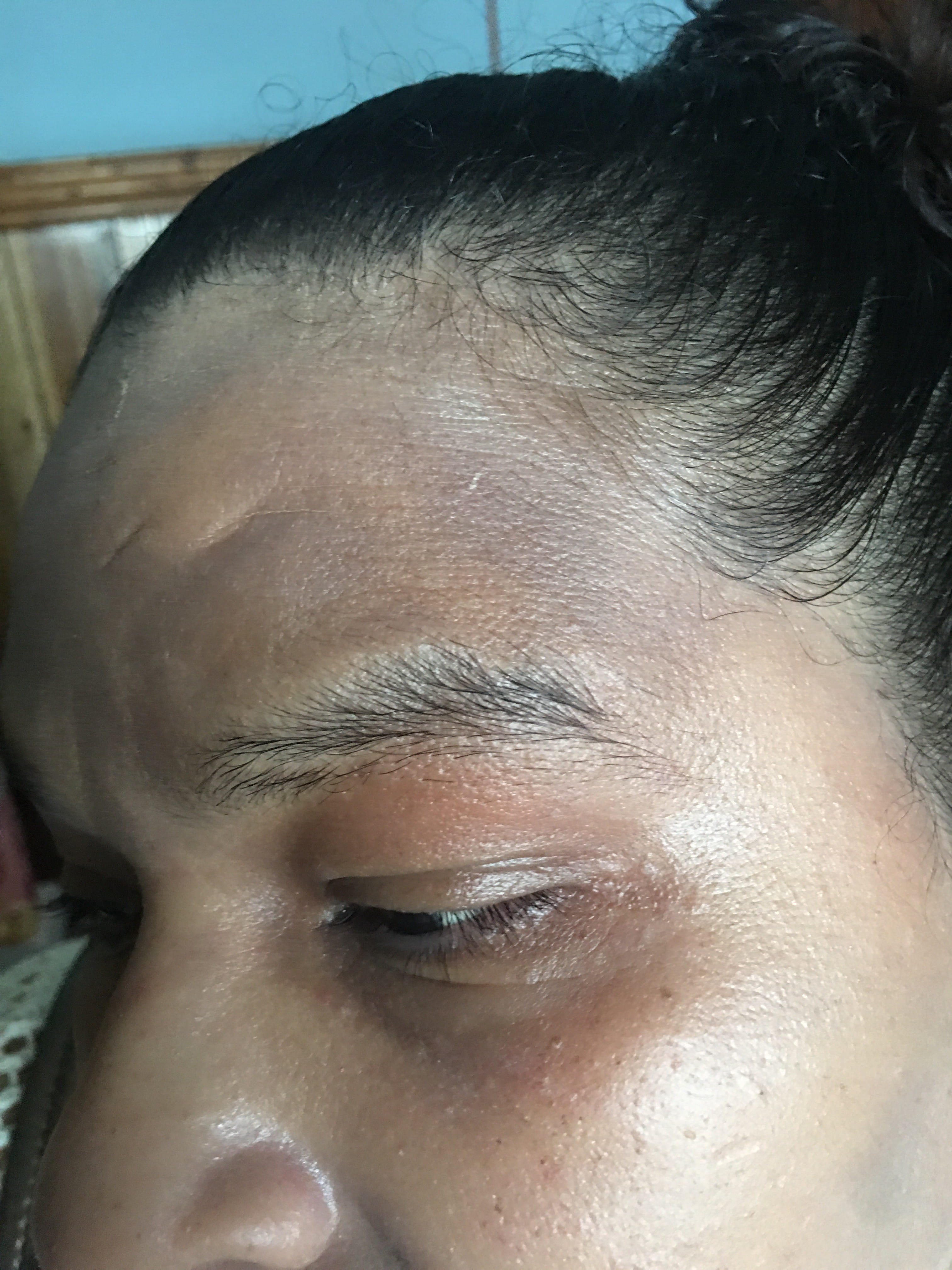 DERMATOSIS CENICIENTA