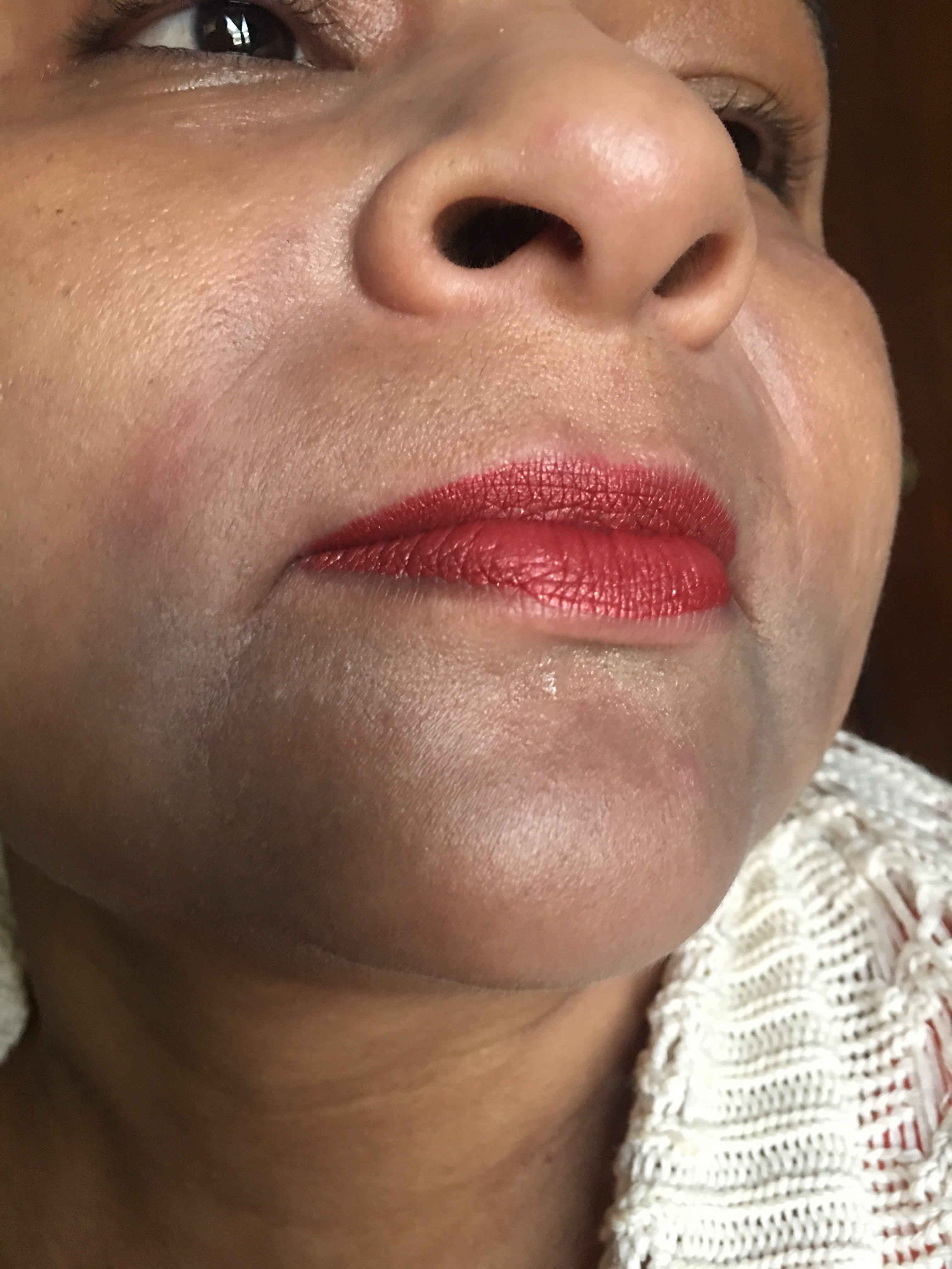 DERMATOSIS CENICIENTA