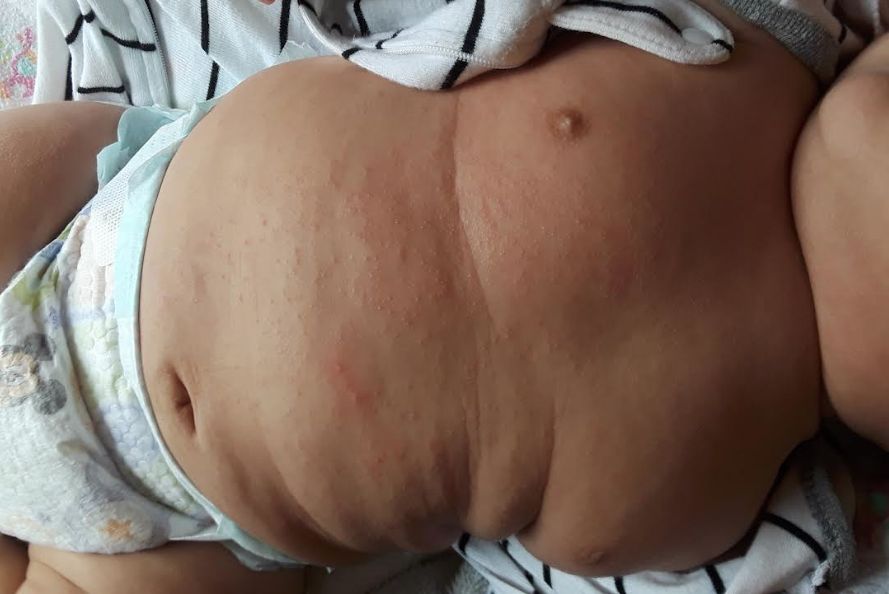 ESCABIOSIS EN NIÑOS