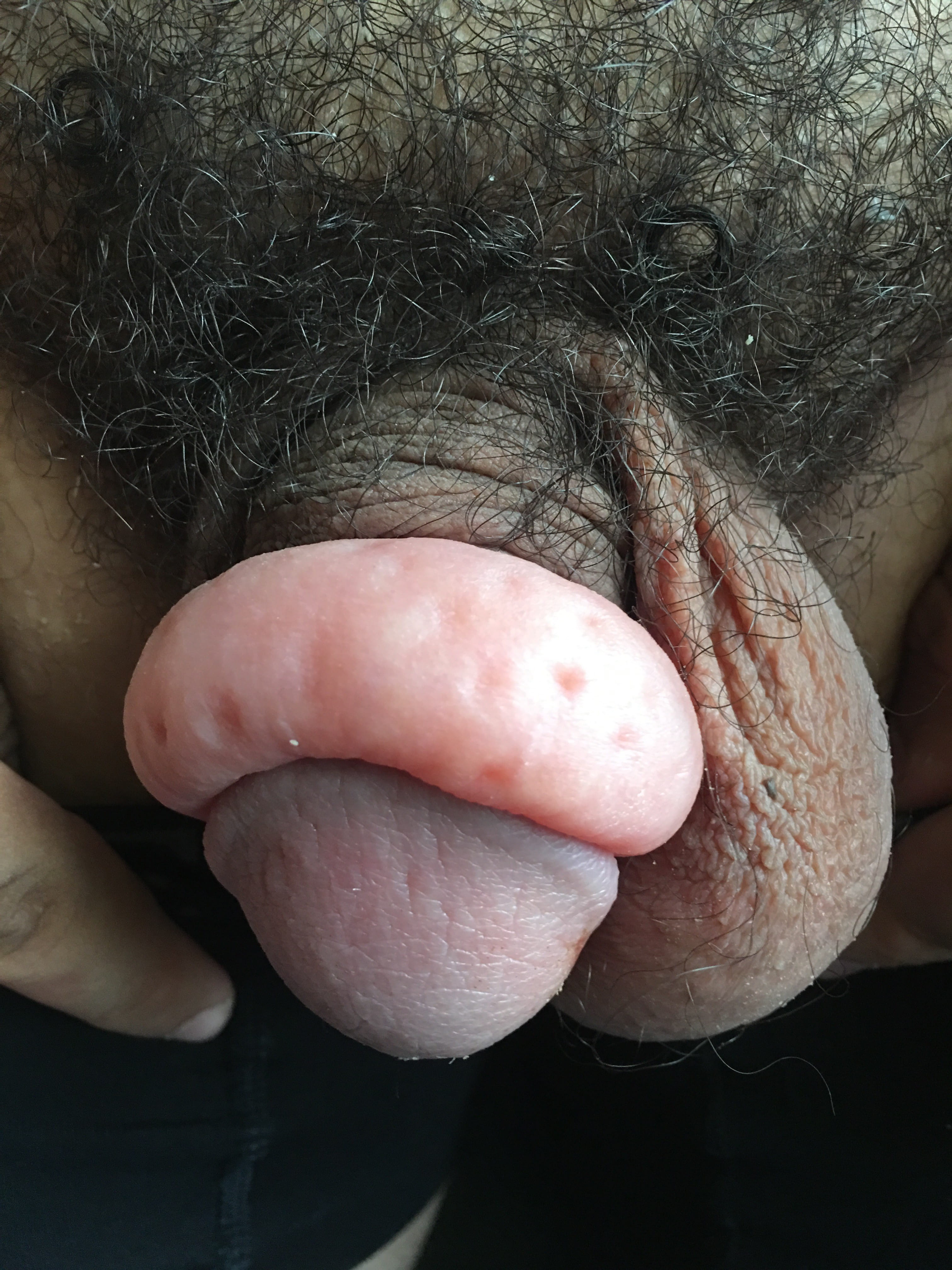 ANGIEDEMA DE PENE