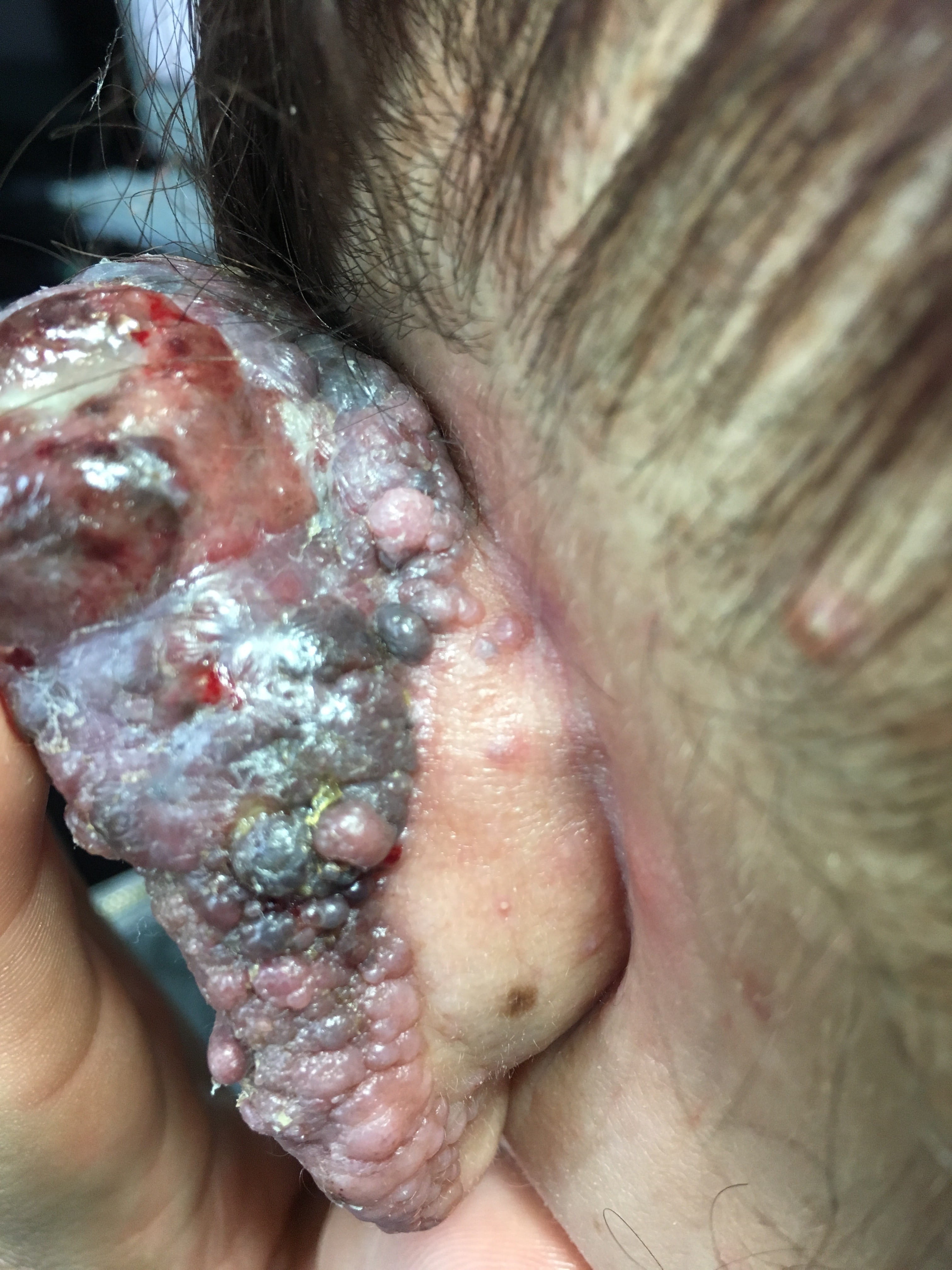 MELANOMA MALIGNO -Oreja