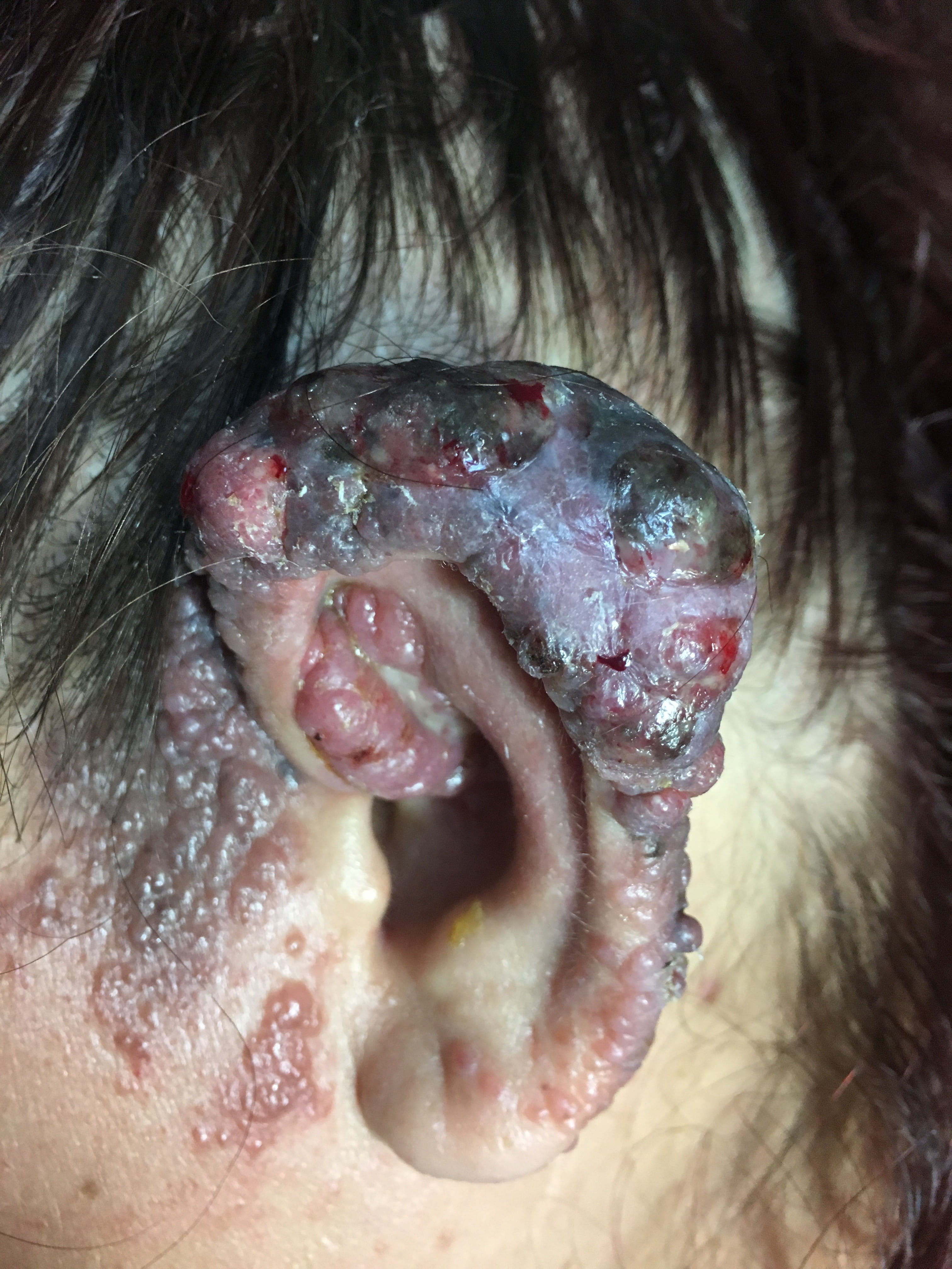 MELANOMA MALIGNO -Oreja