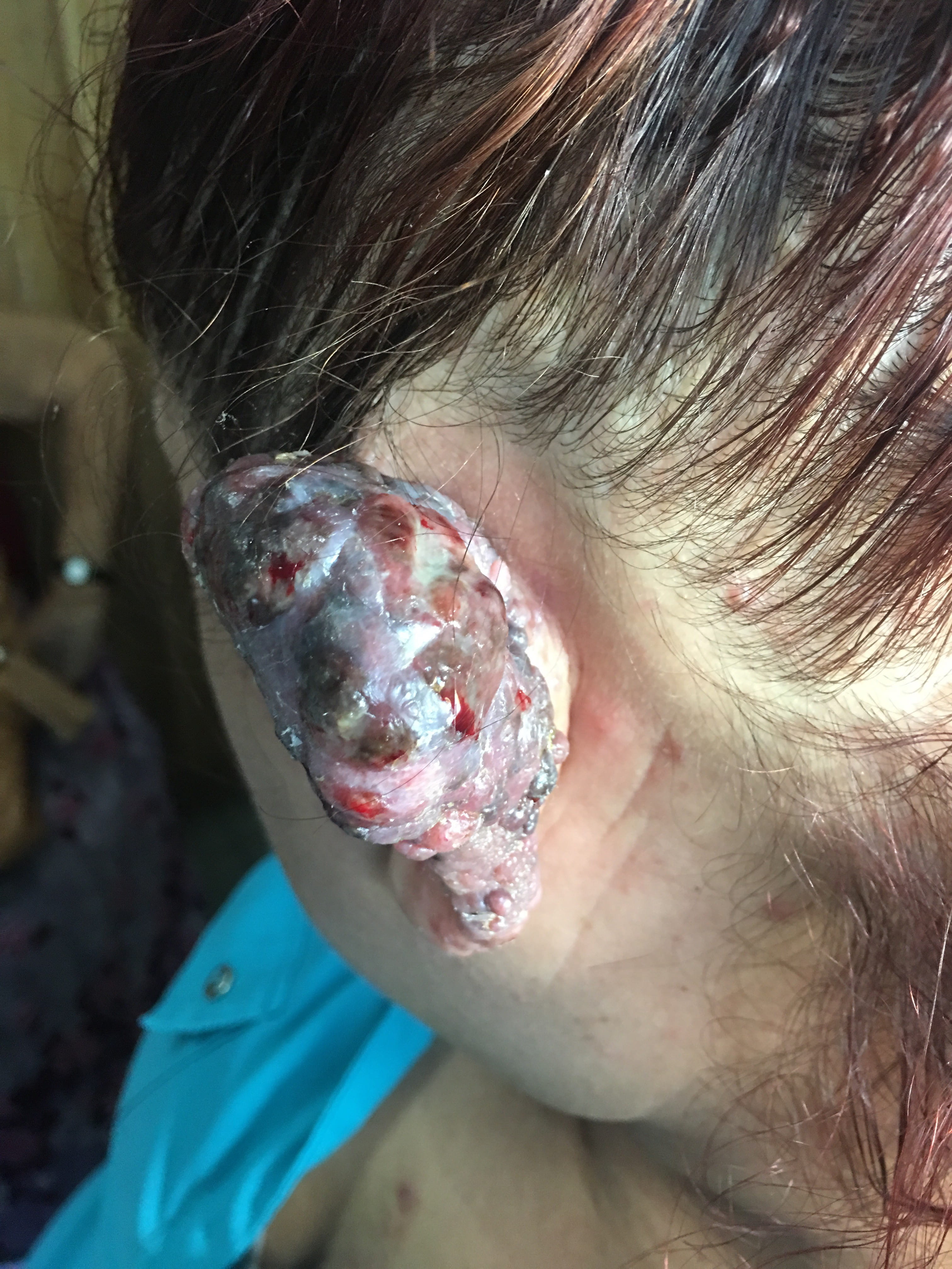 MELANOMA MALIGNO -Oreja
