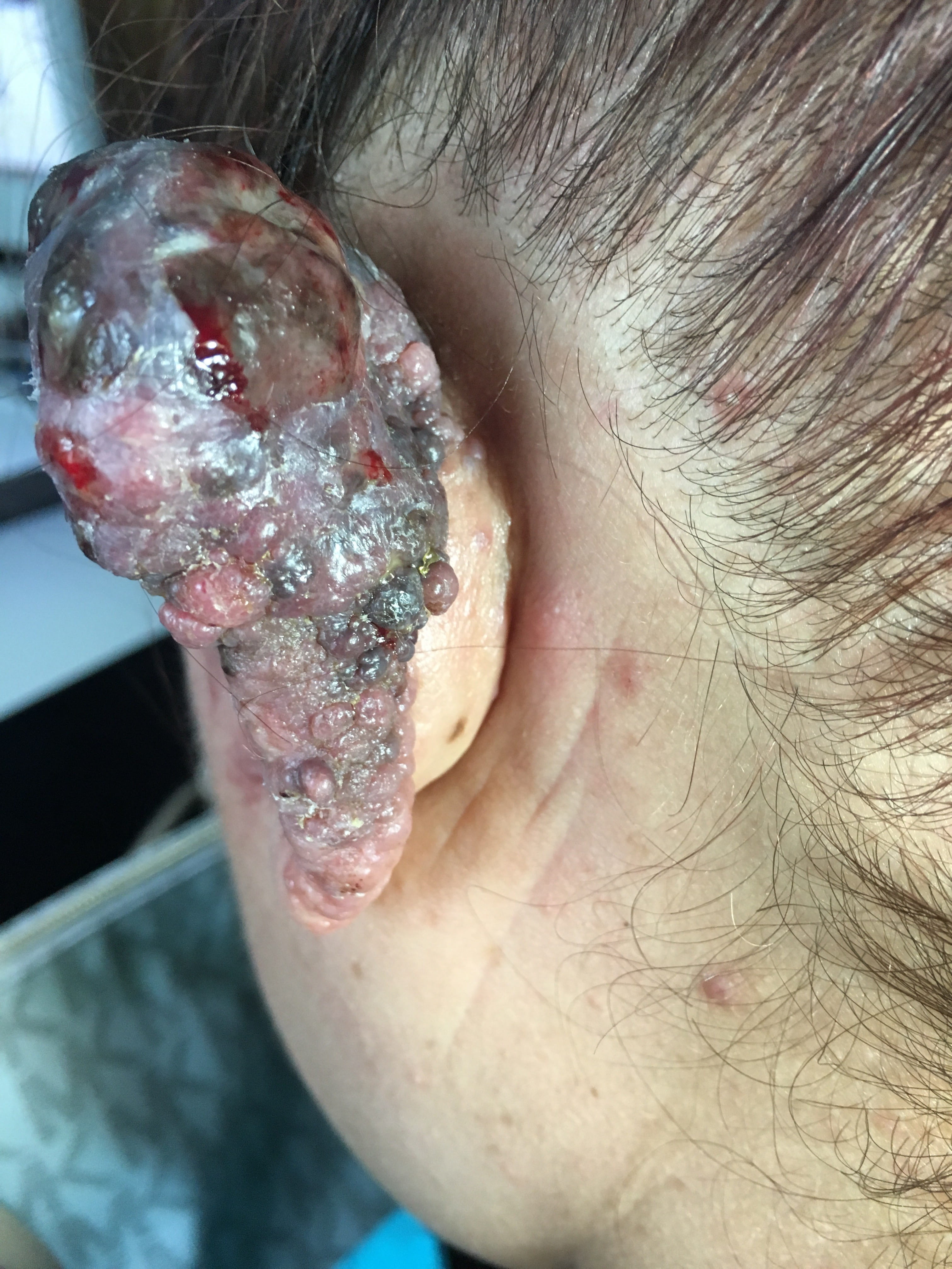 MELANOMA MALIGNO -Oreja