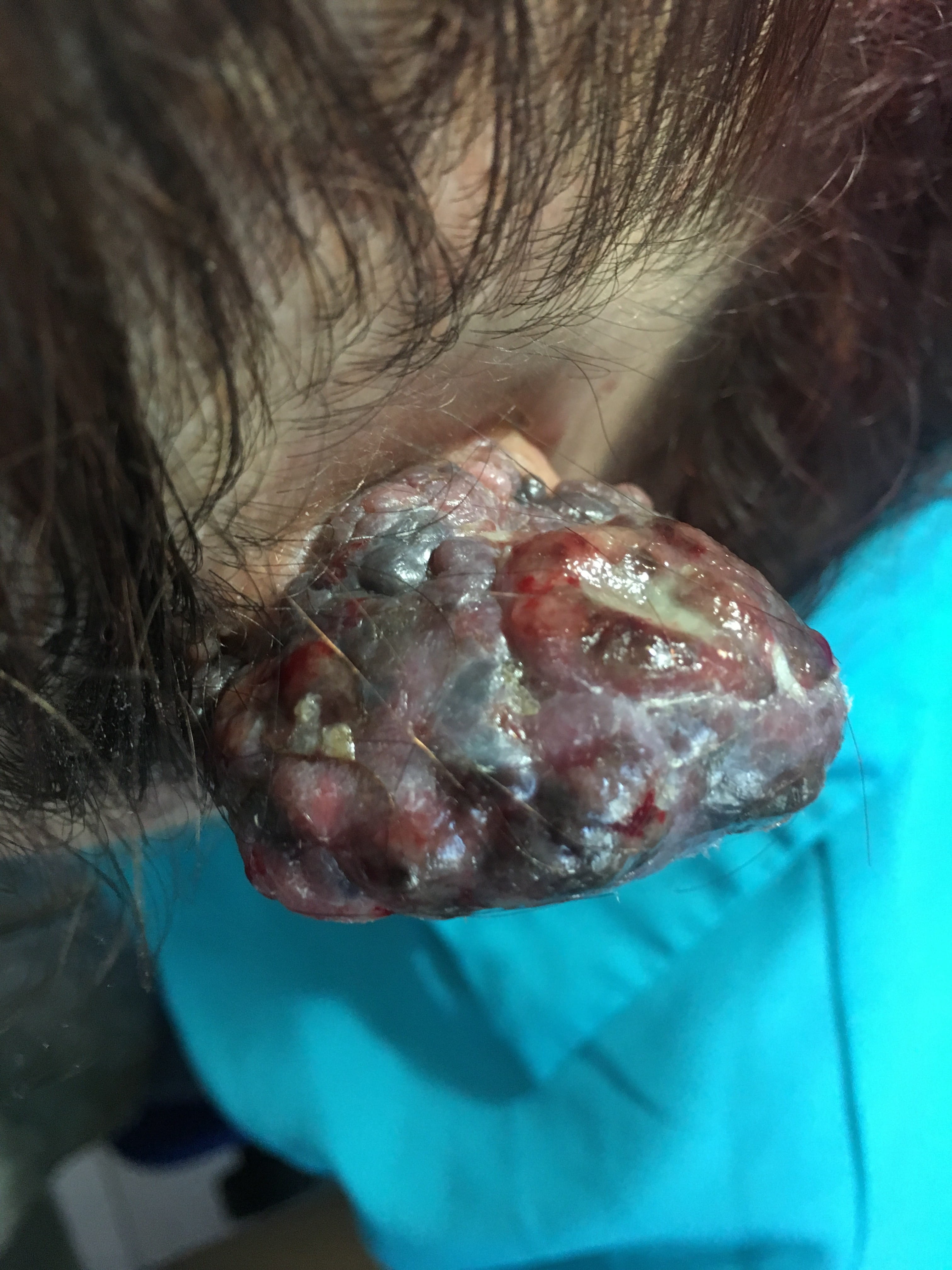 MELANOMA MALIGNO -Oreja