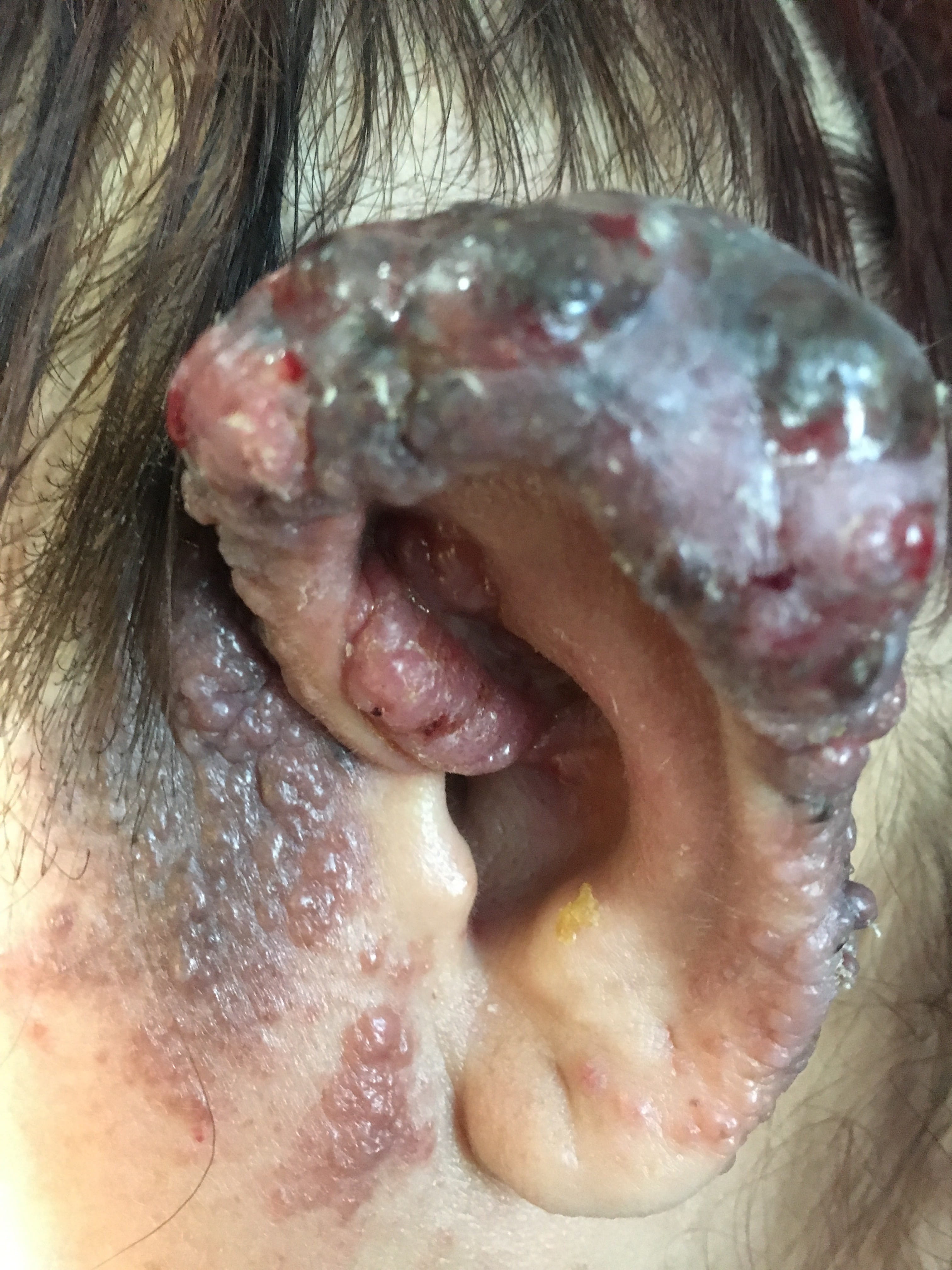MELANOMA MALIGNO -Oreja