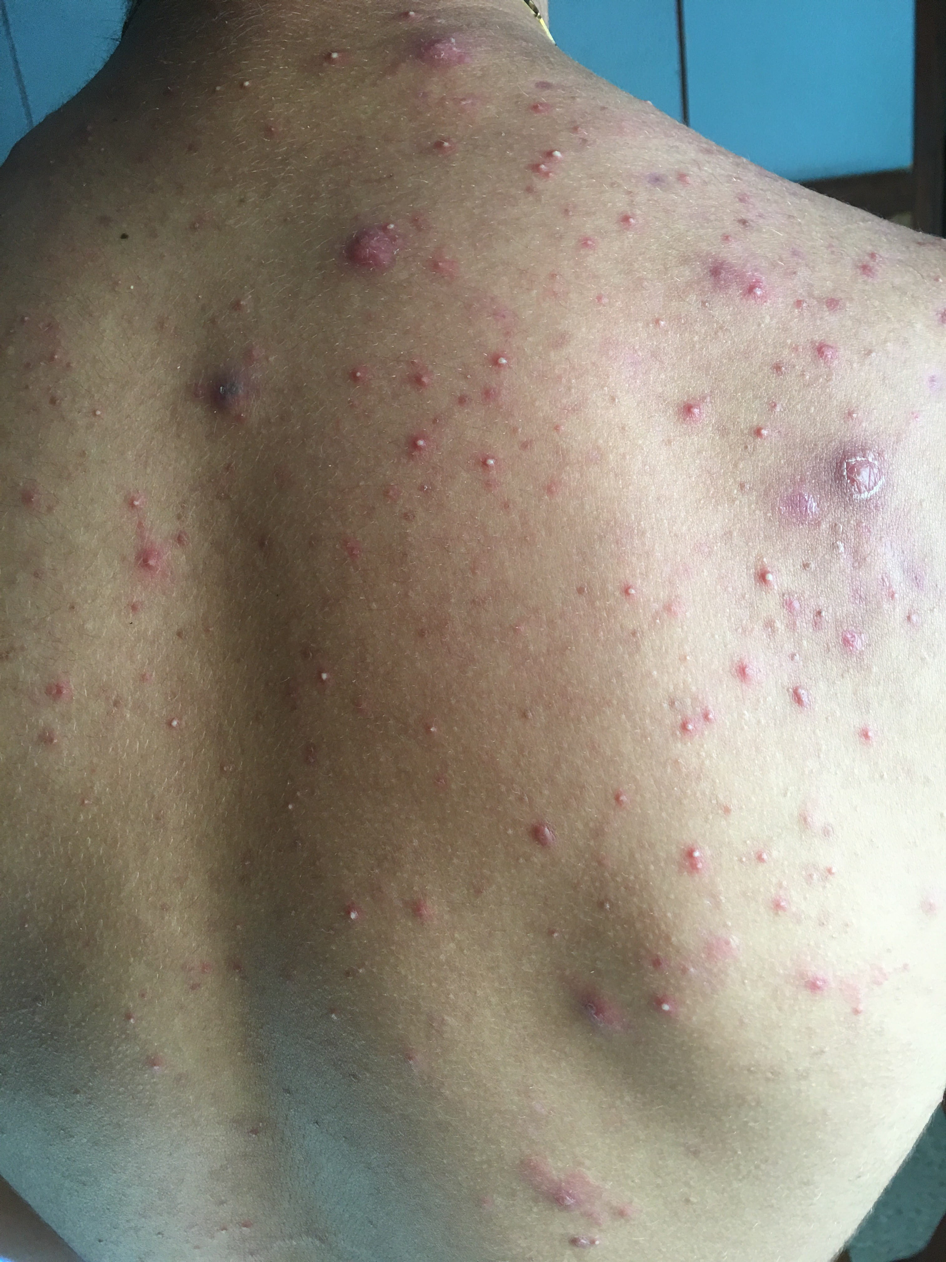 ACNE JUVENIL