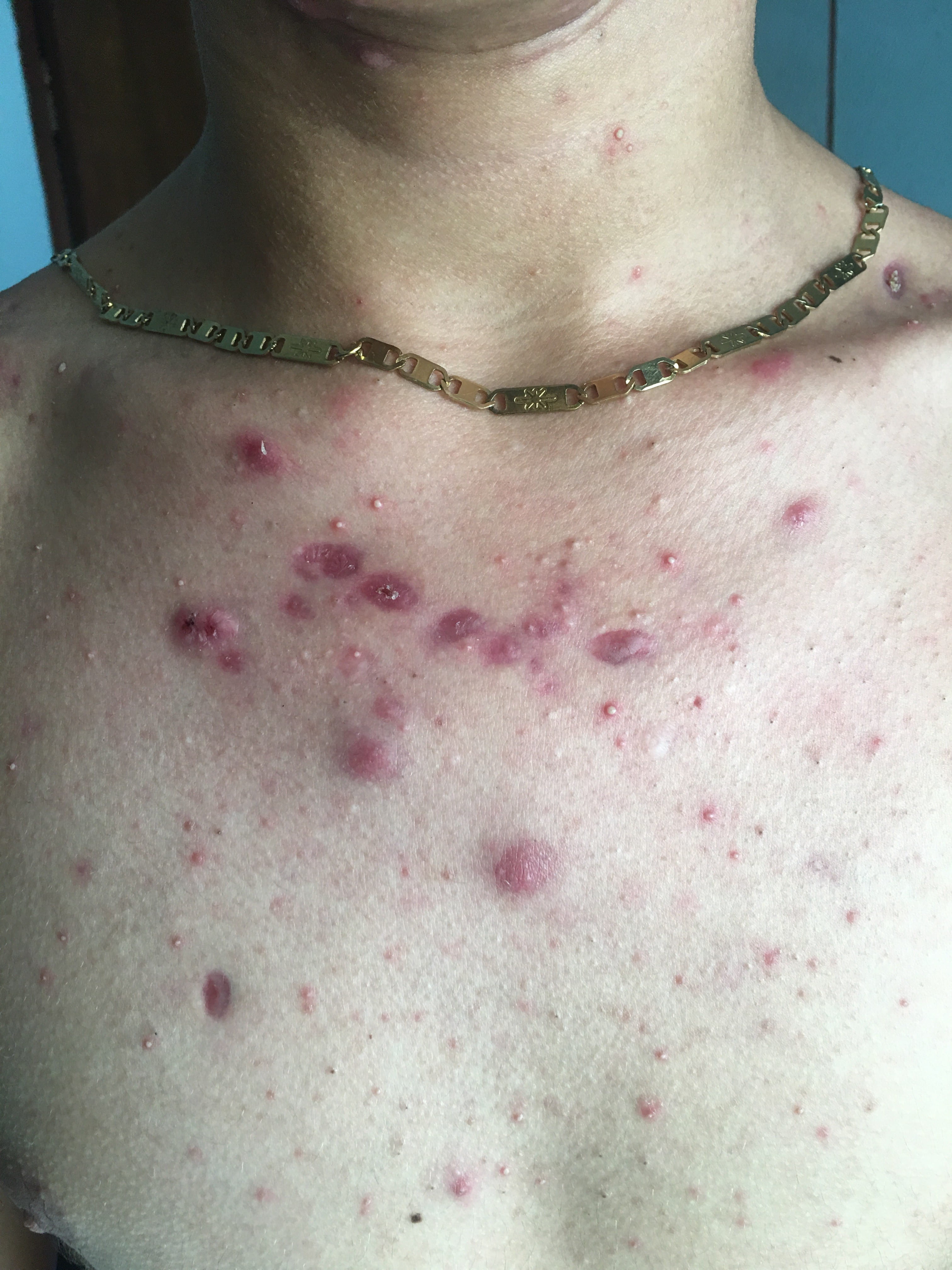 ACNE JUVENIL