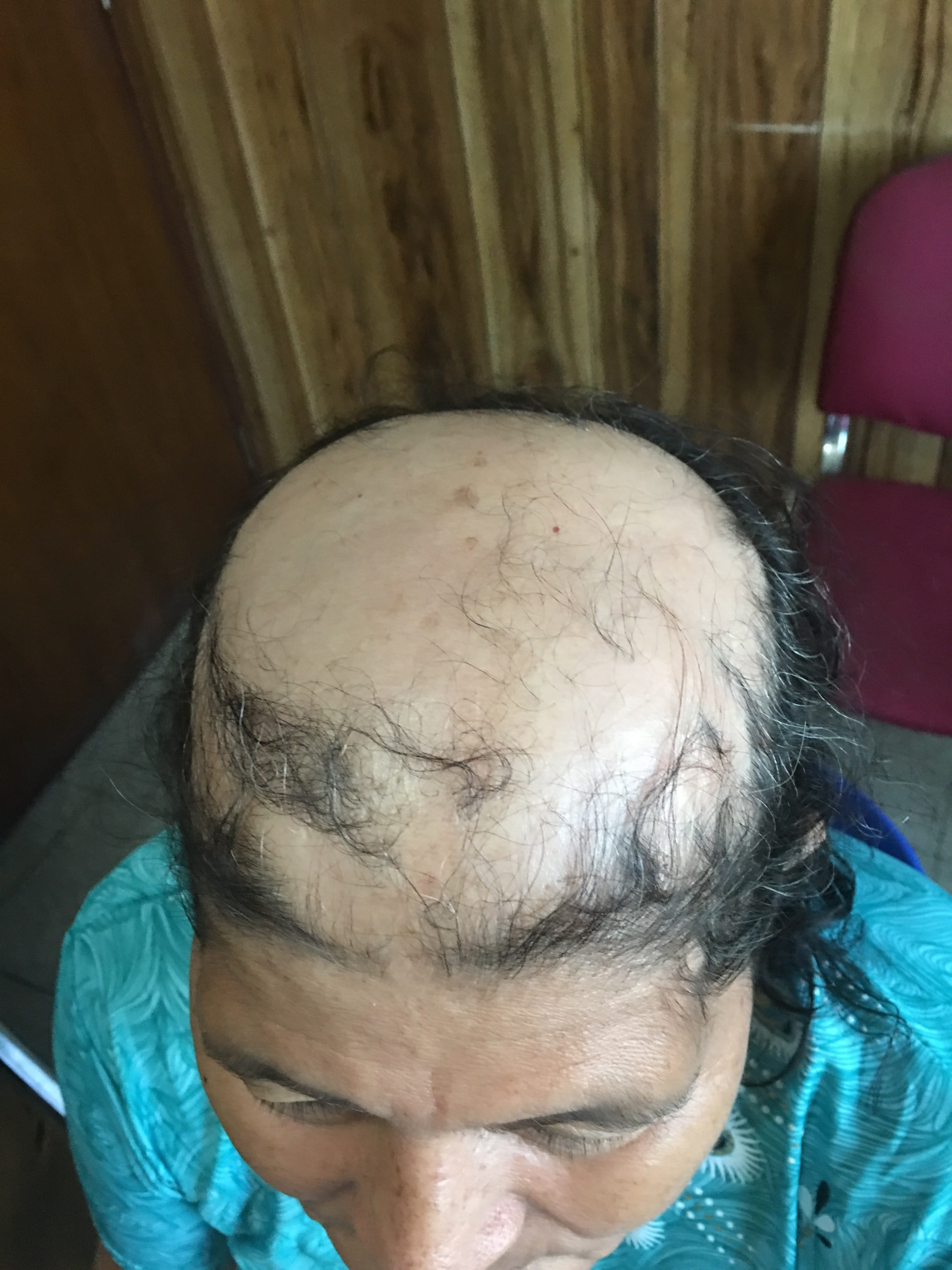 ALOPECIA AREATA