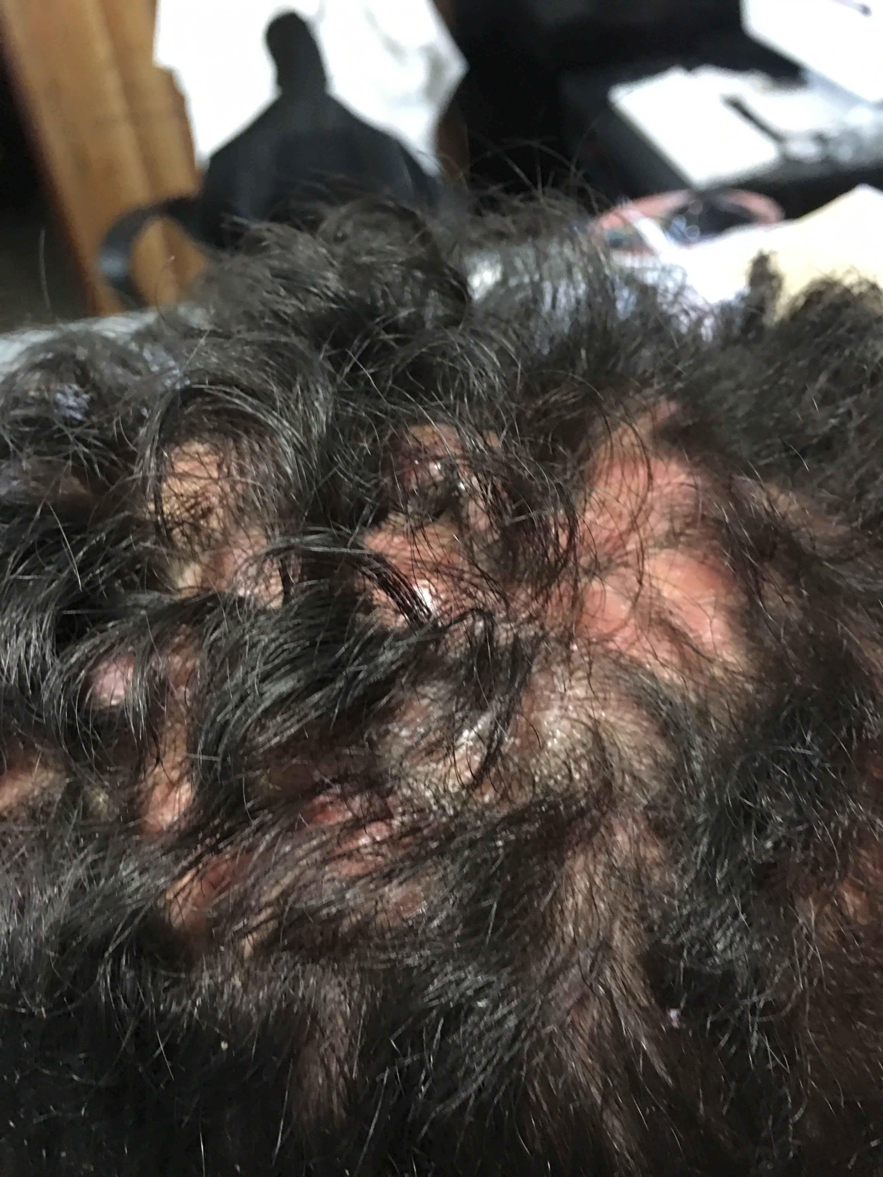 FOLICULITIS DECALVANTE