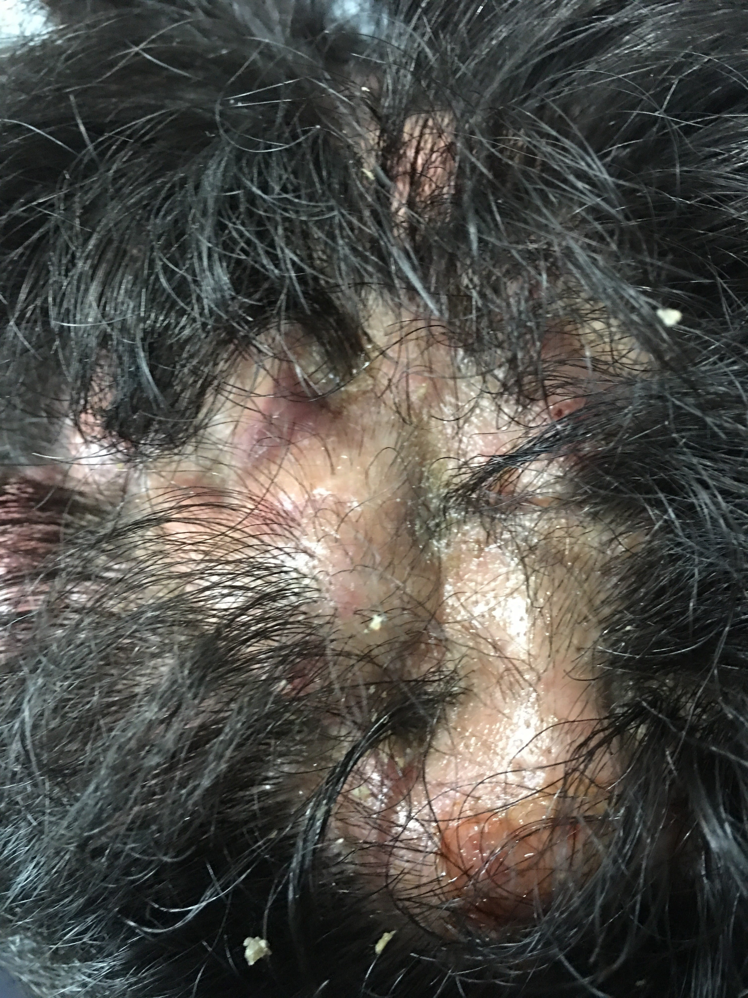 FOLICULITIS DECALVANTE