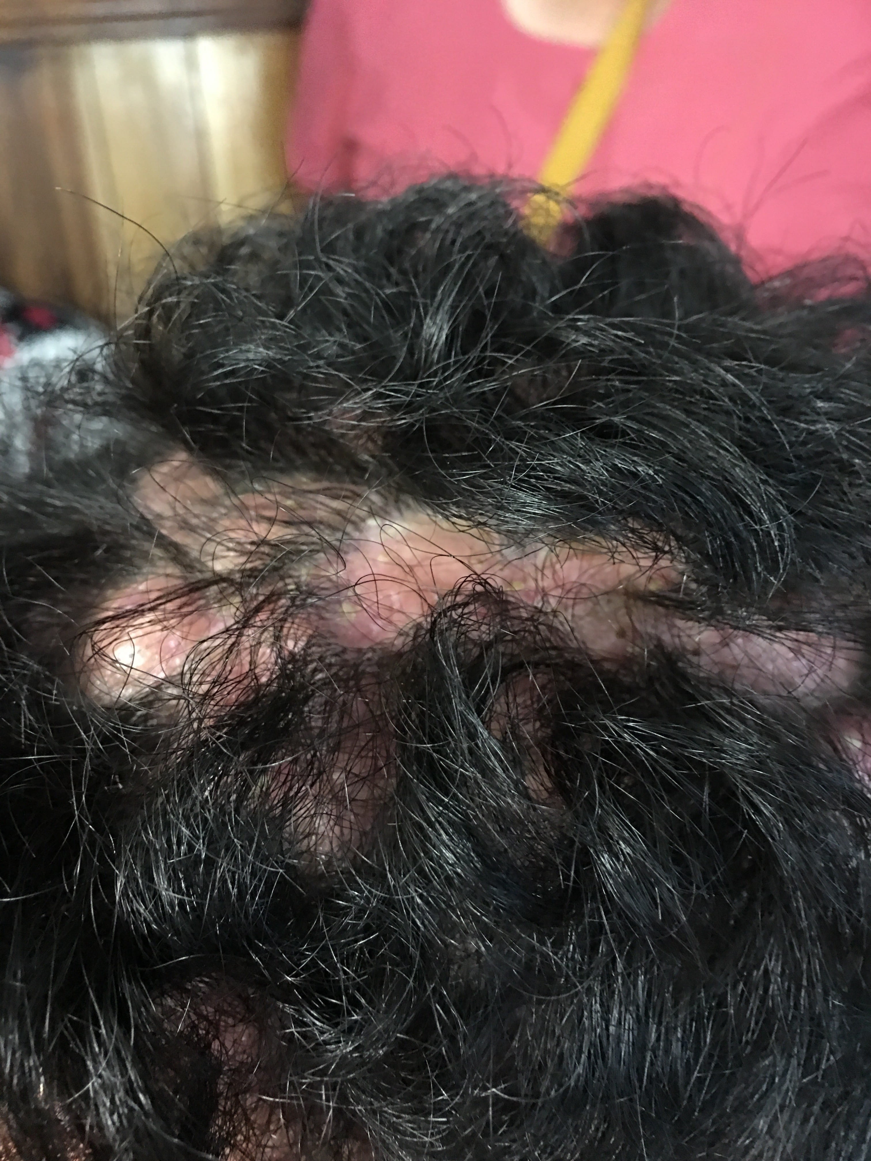 FOLICULITIS DECALVANTE