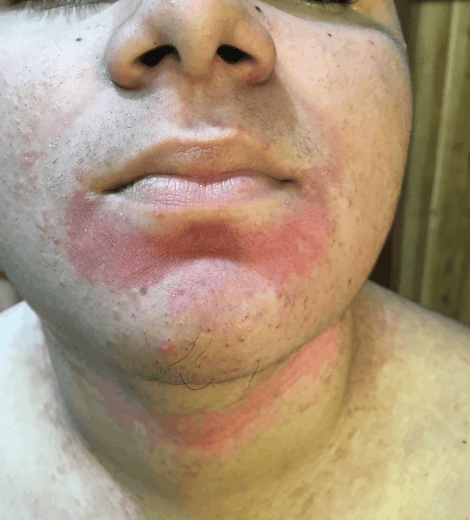 DERMATITIS SEBORREICA
