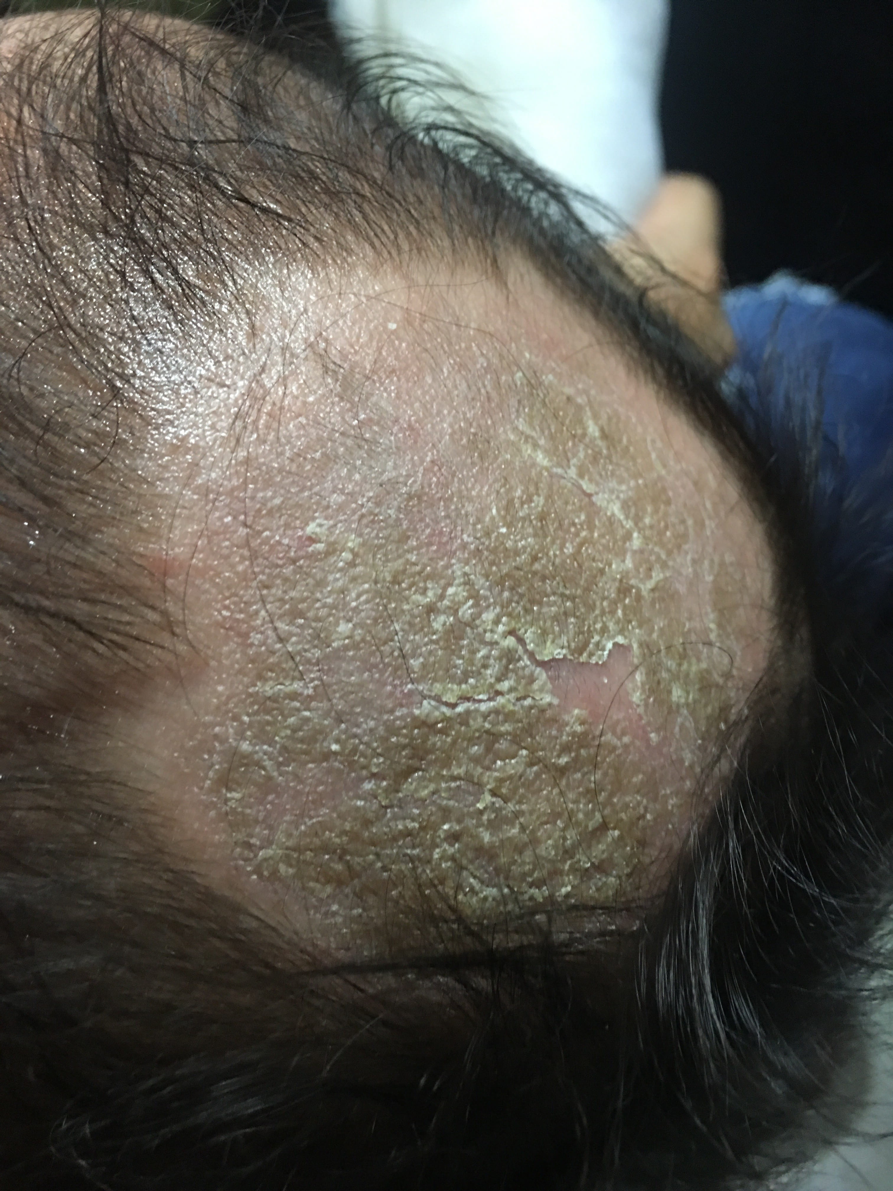 DERMATITIS SEBORREICA