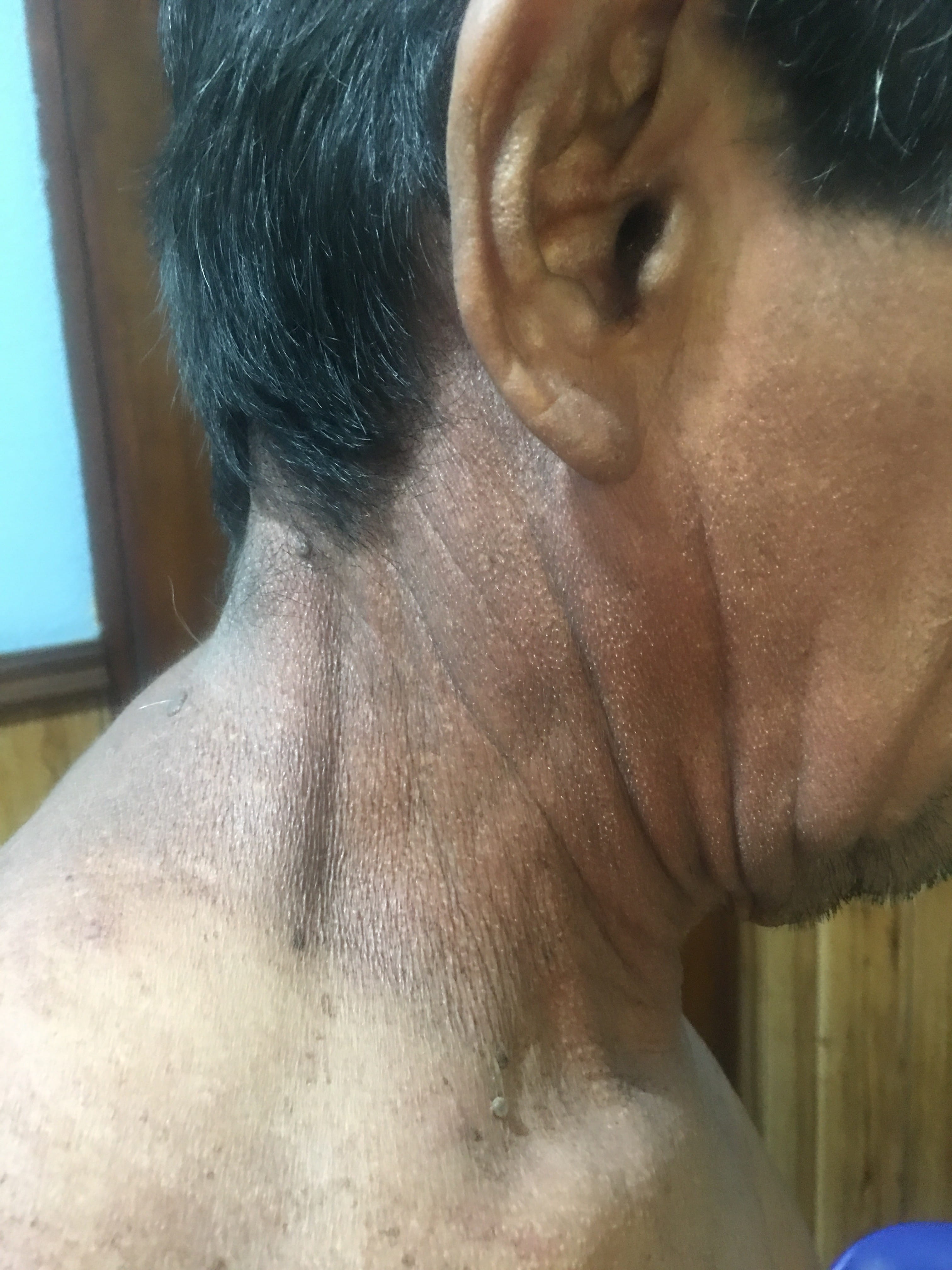 DERMATOSIS CENICIENTA