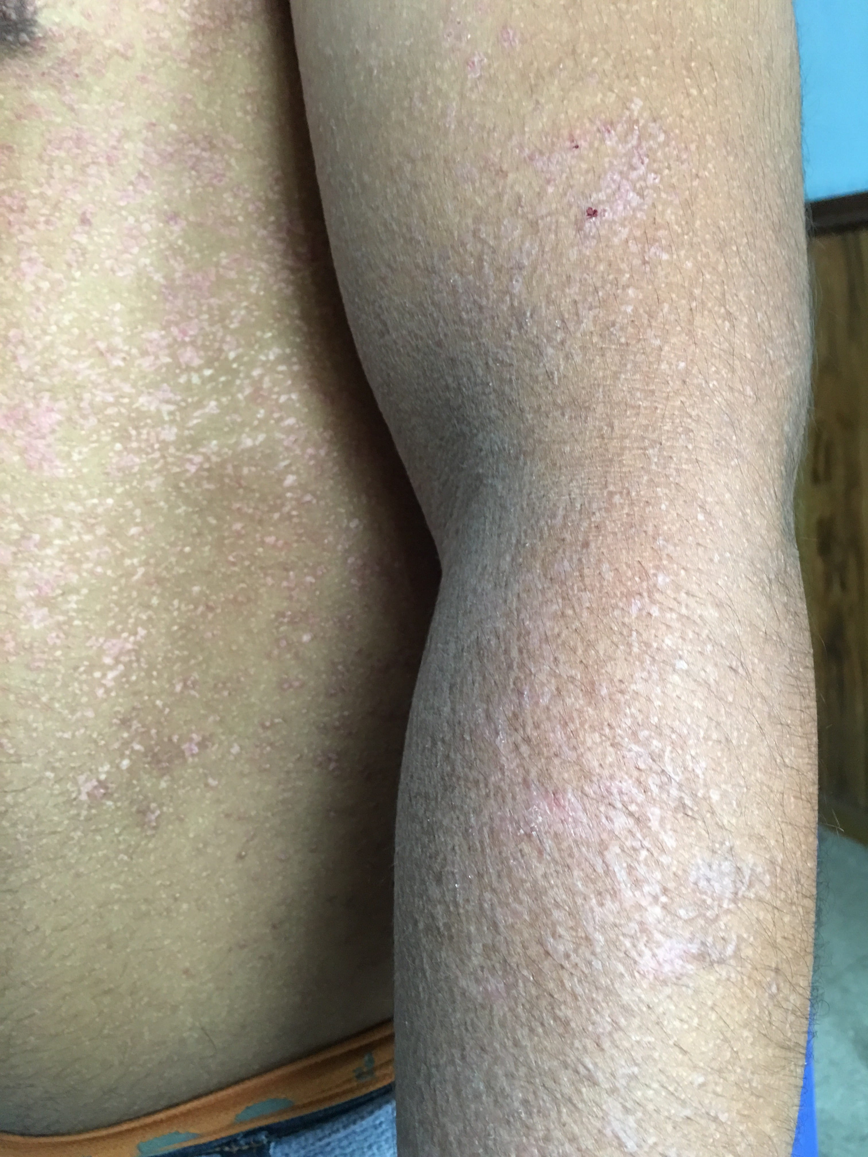 ENFERMEDAD DE DARIER