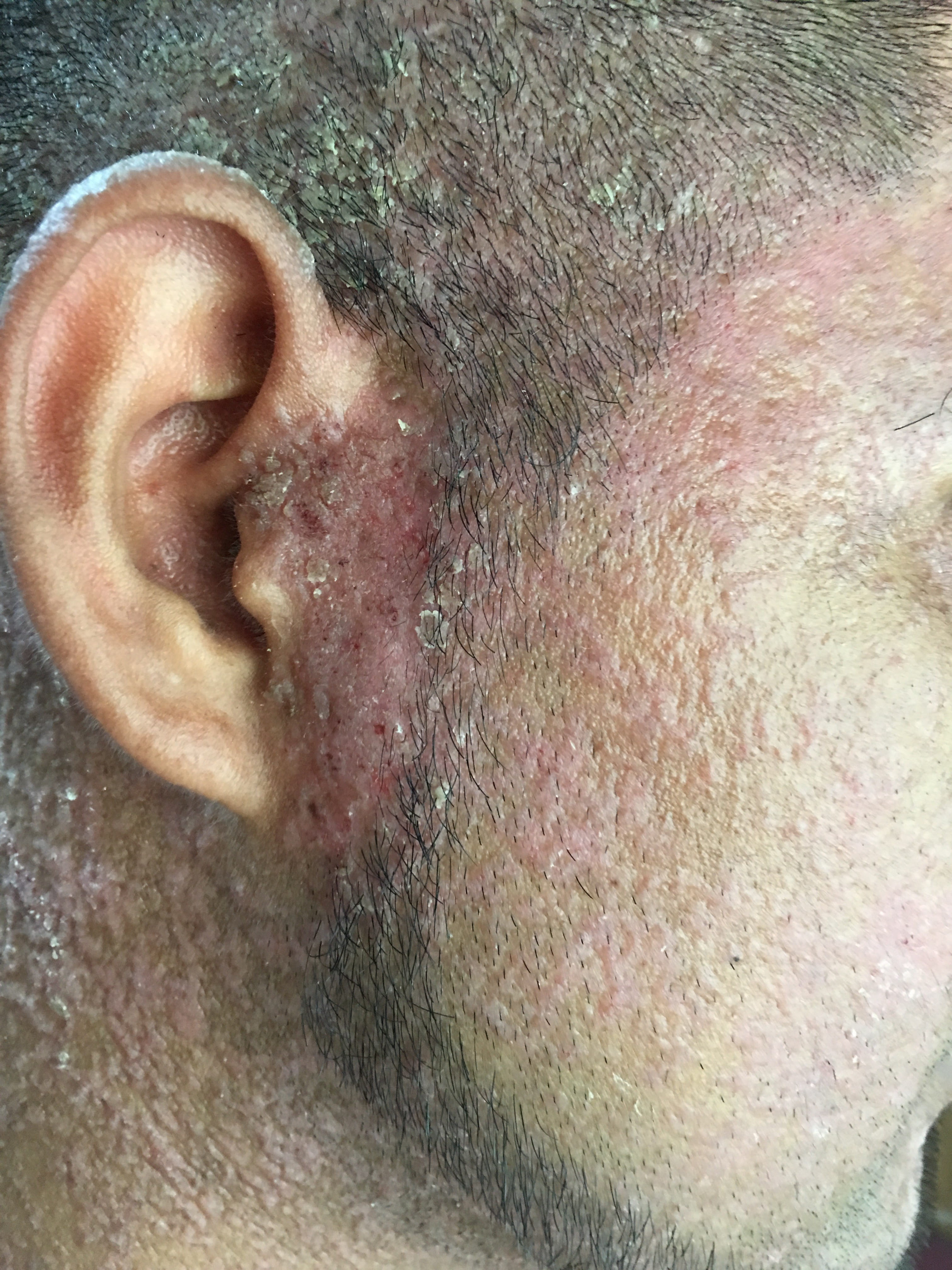 ENFERMEDAD DE DARIER