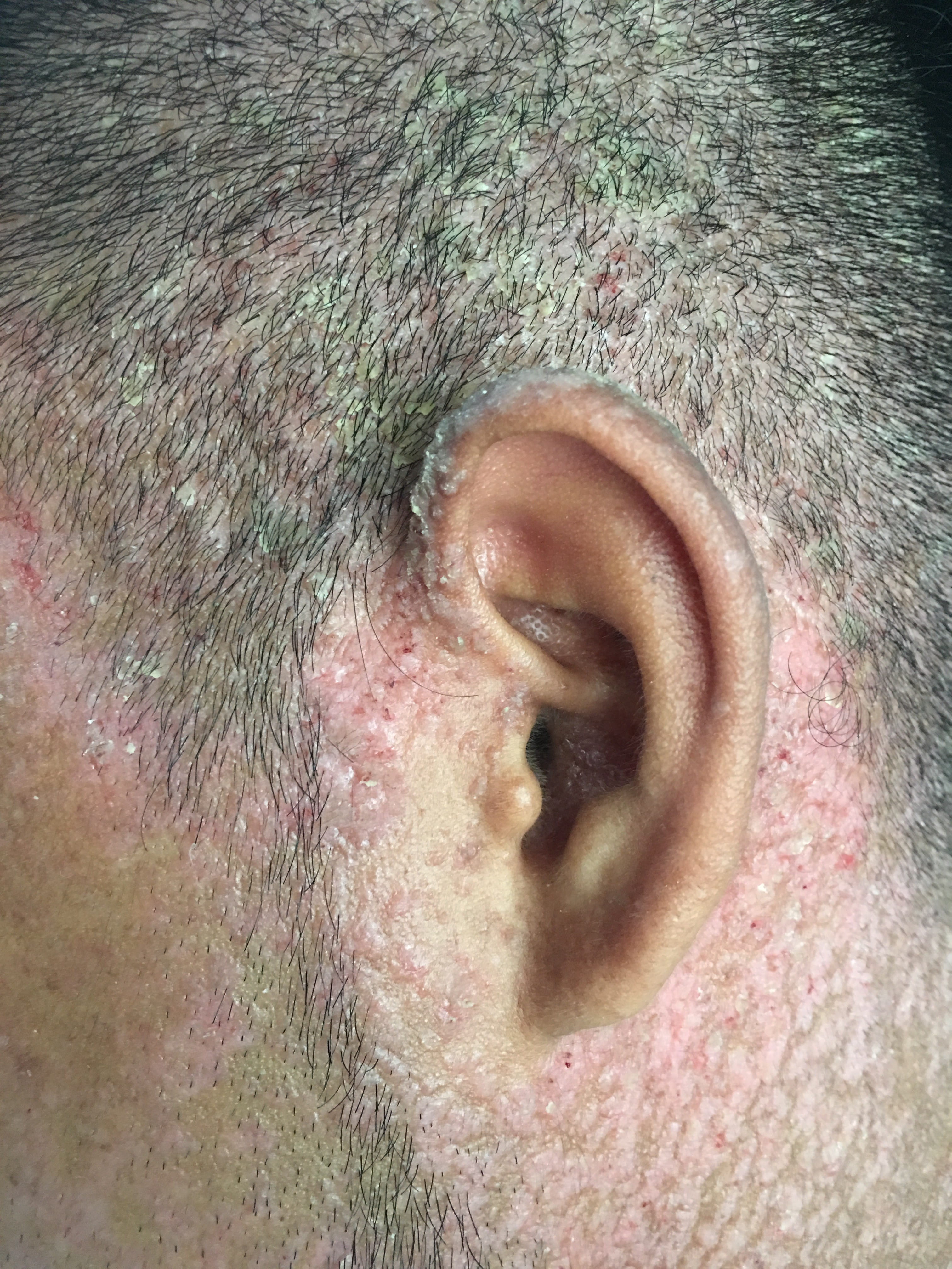 ENFERMEDAD DE DARIER