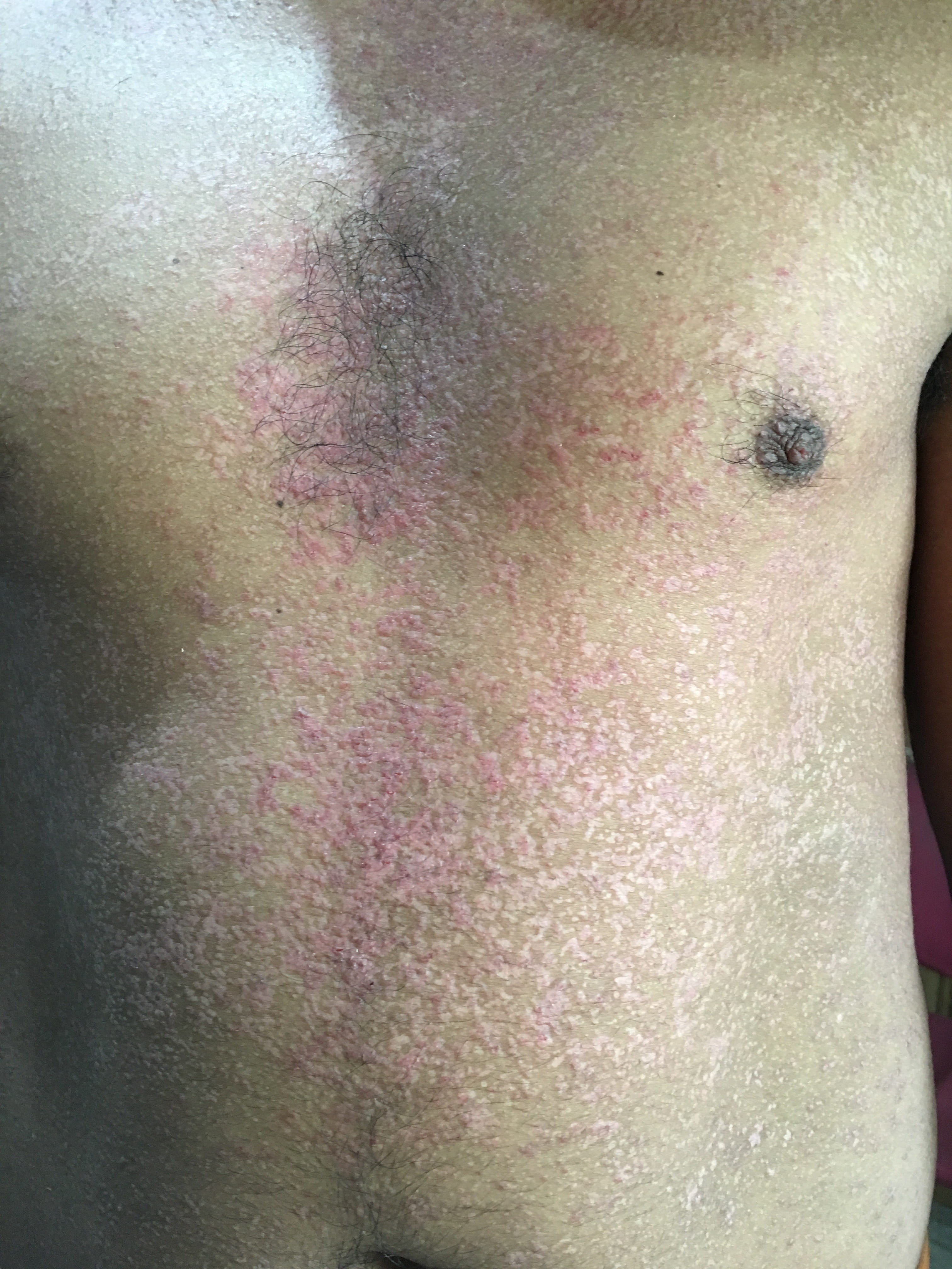 ENFERMEDAD DE DARIER