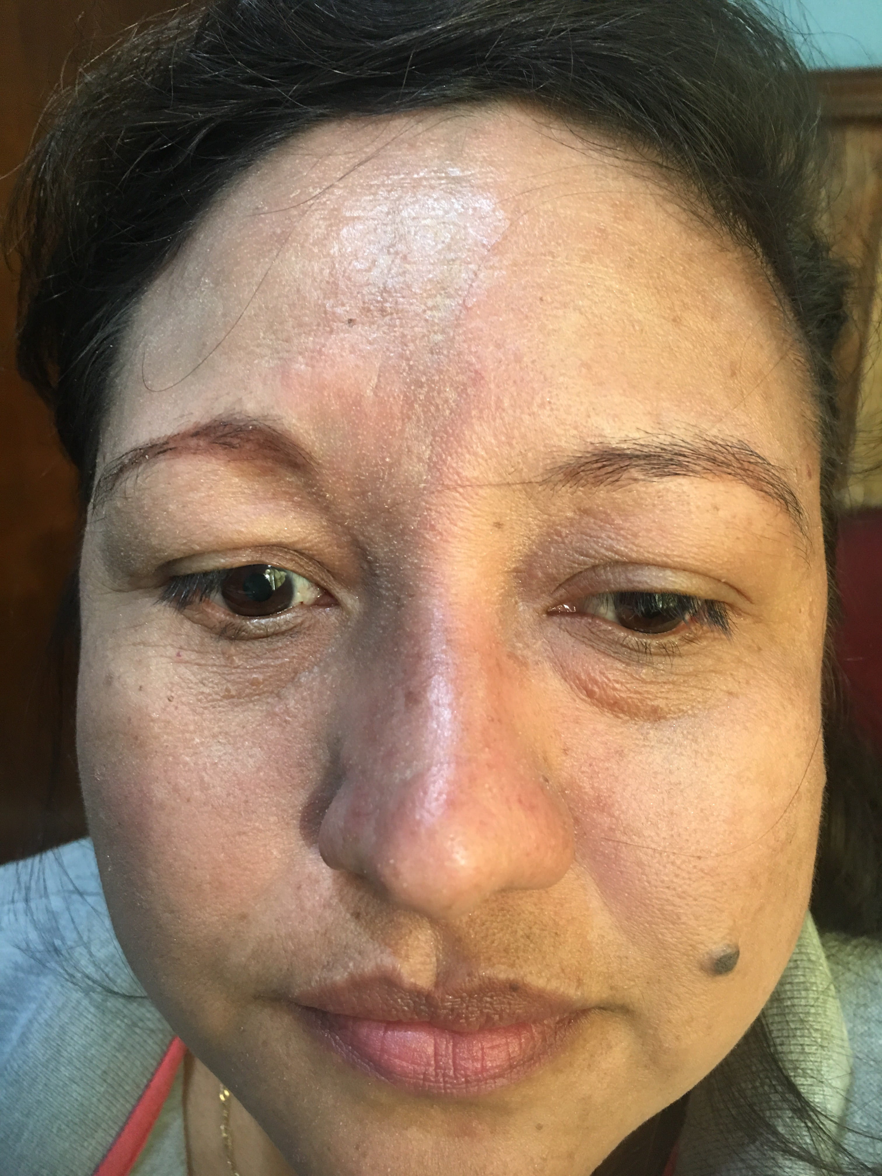 ESCLERODERMIA CUTANEA en golpe de sable