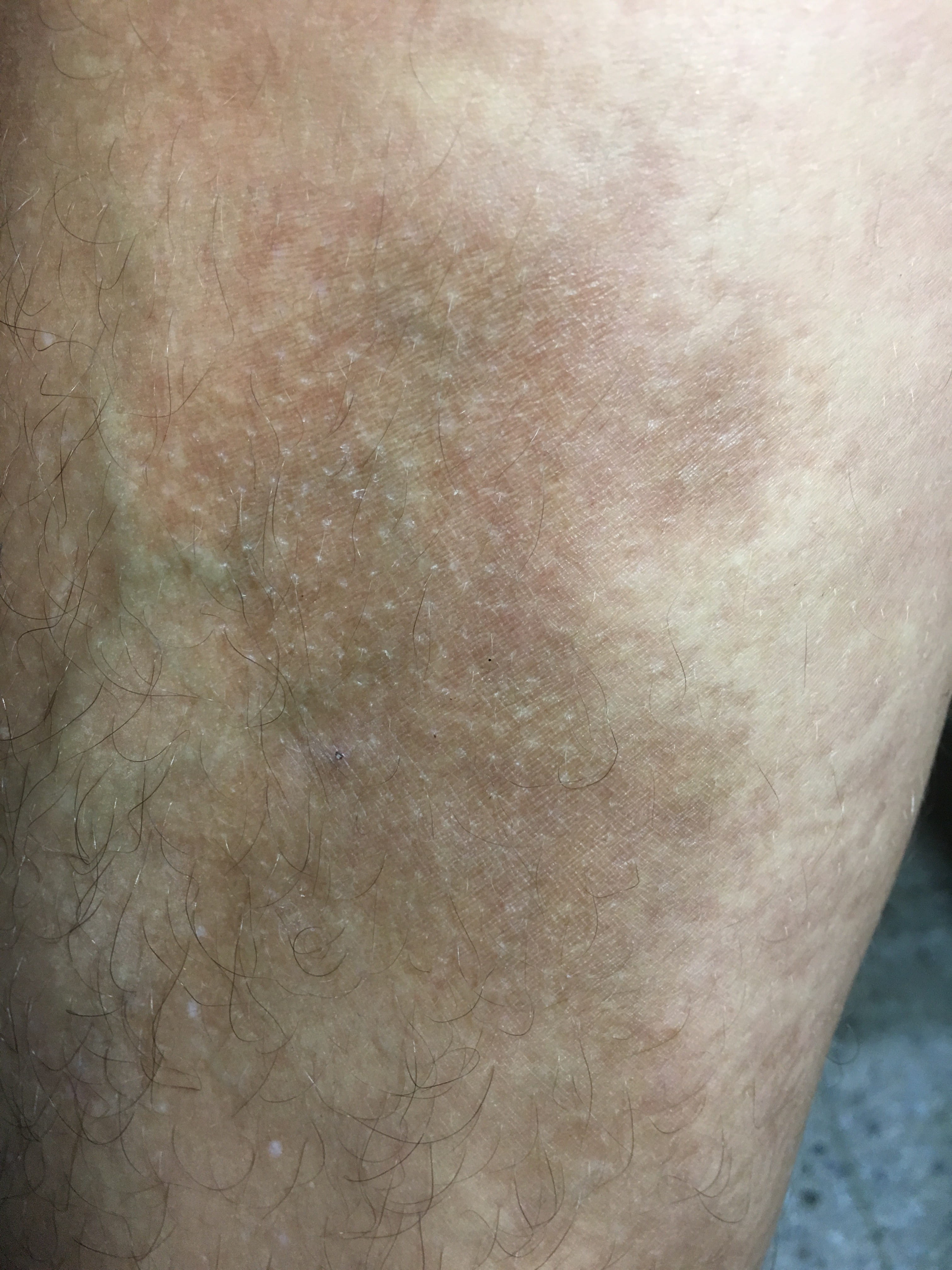 ESCLERODERMIA CUTANEA en placa