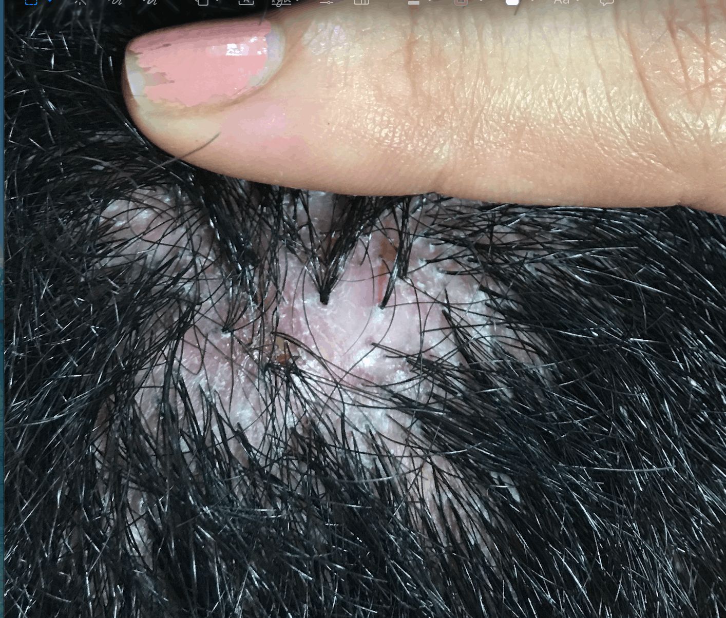 FOLICULITIS DECALVANTE