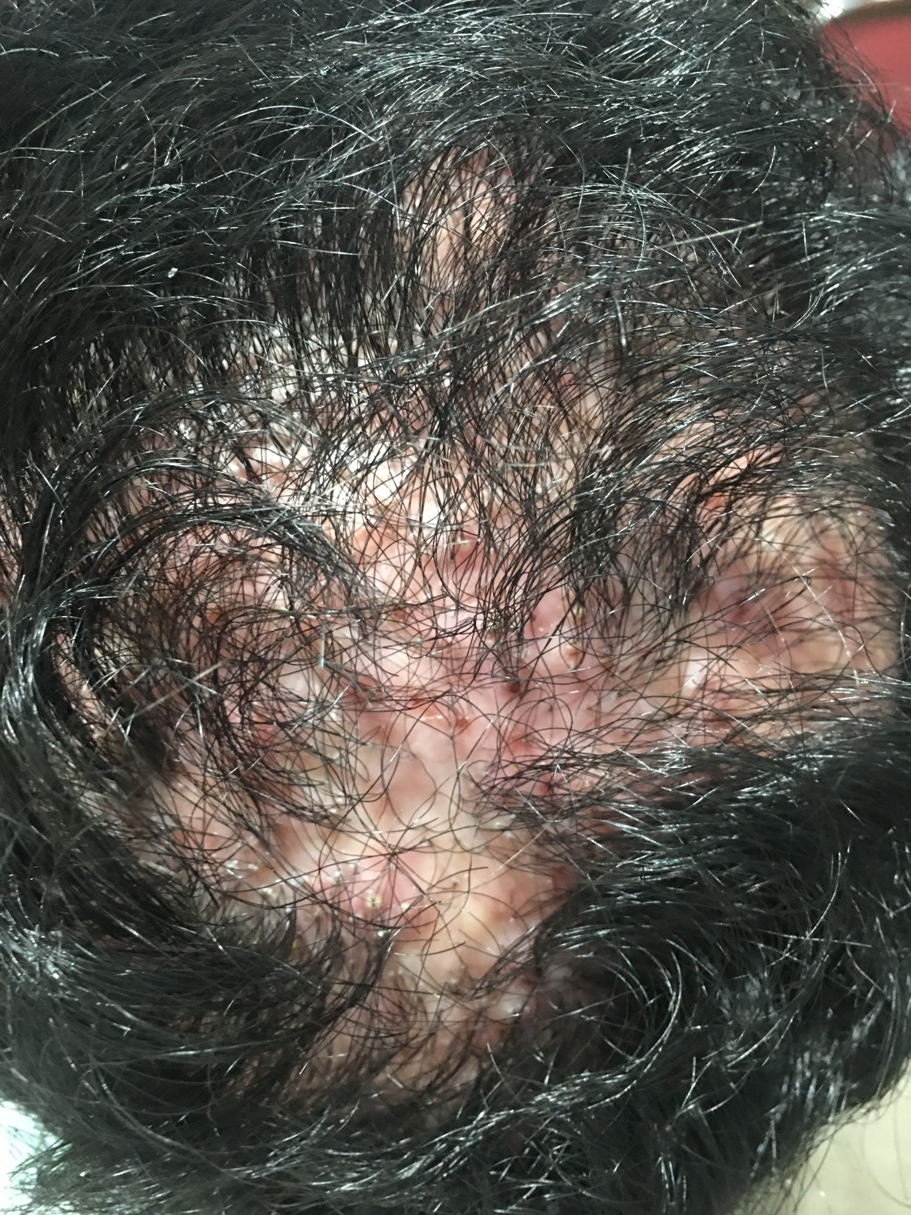 FOLICULITIS DECALVANTE