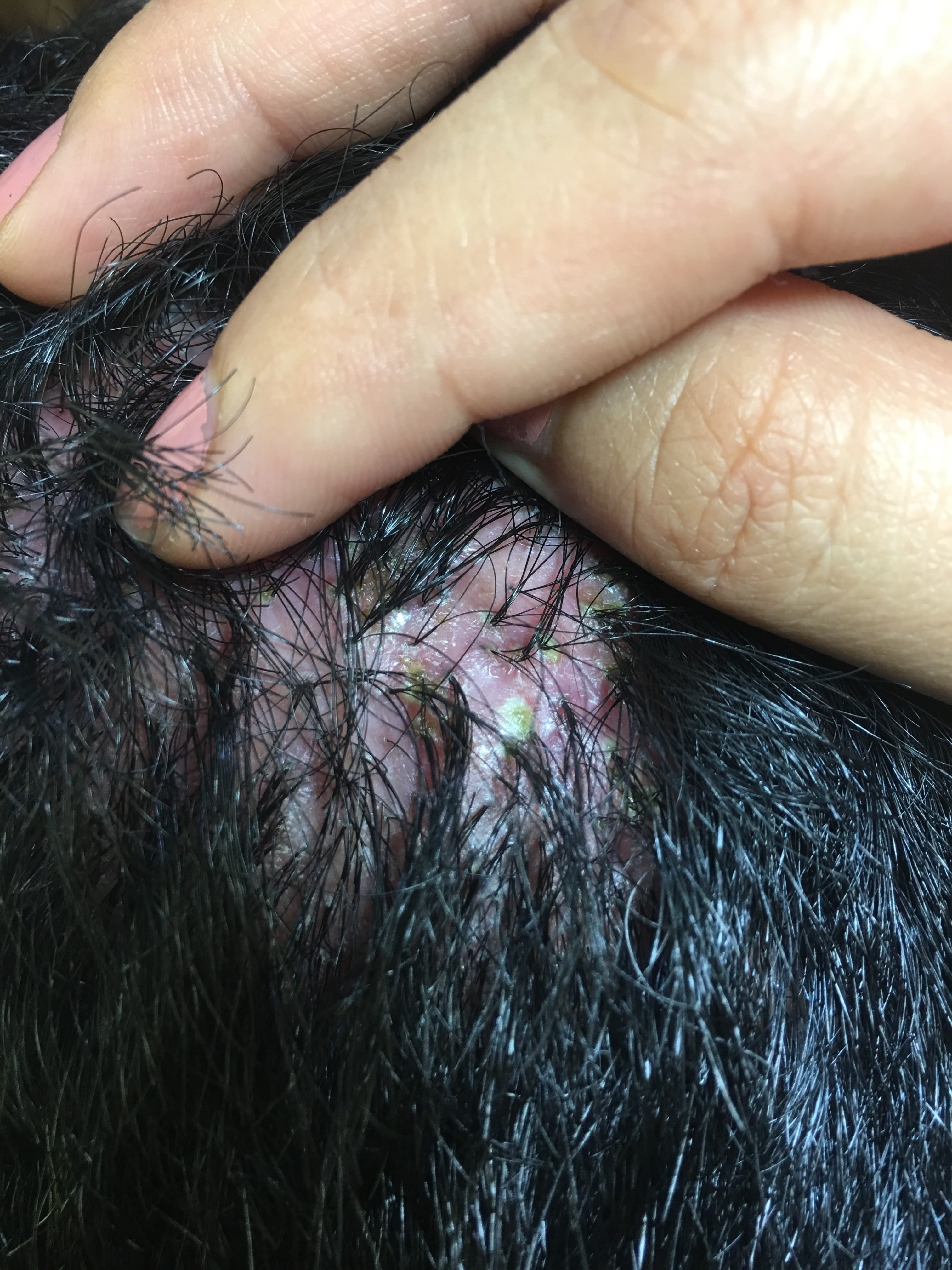 FOLICULITIS DECALVANTE