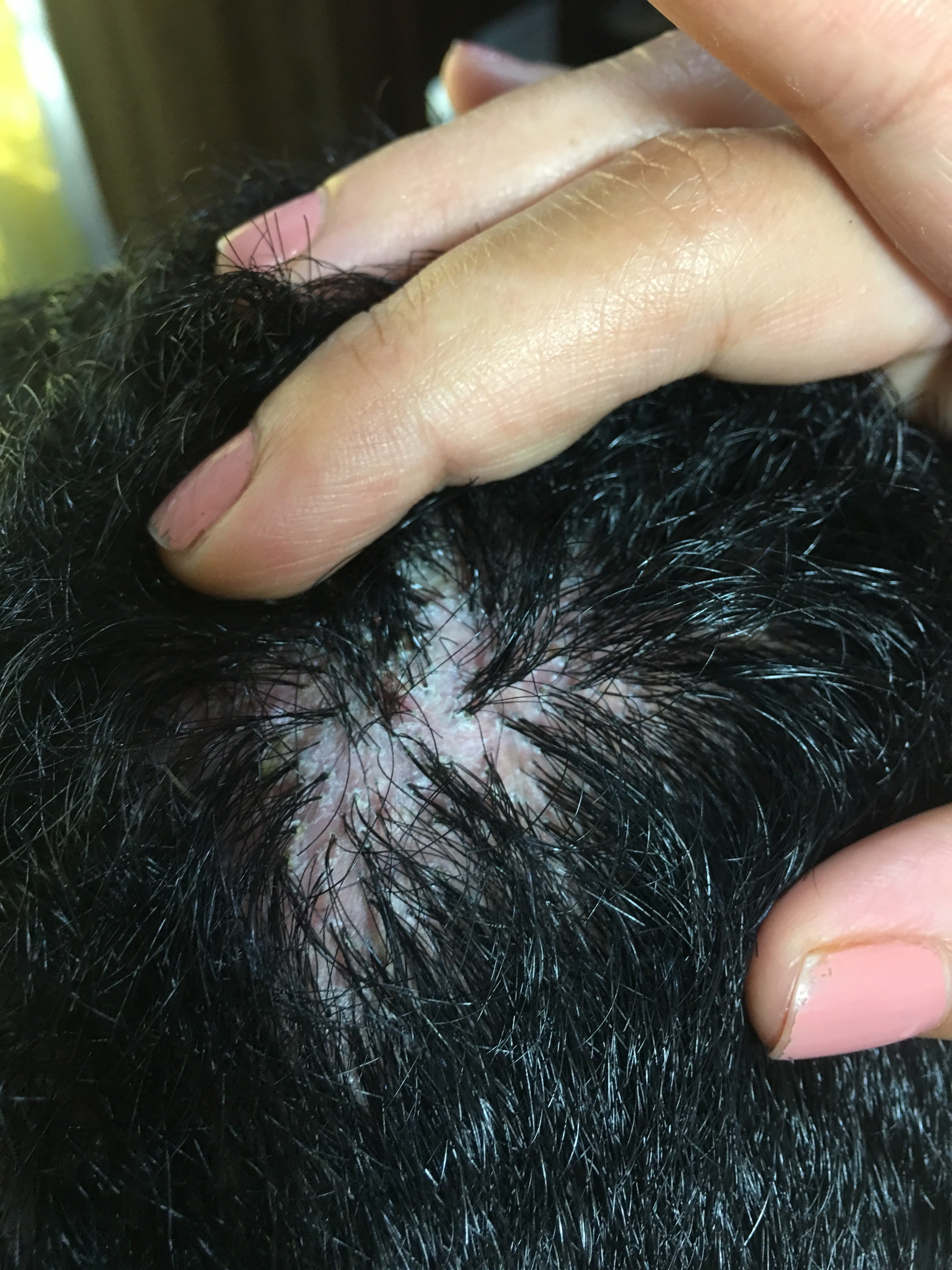 FOLICULITIS DECALVANTE - Politriquia