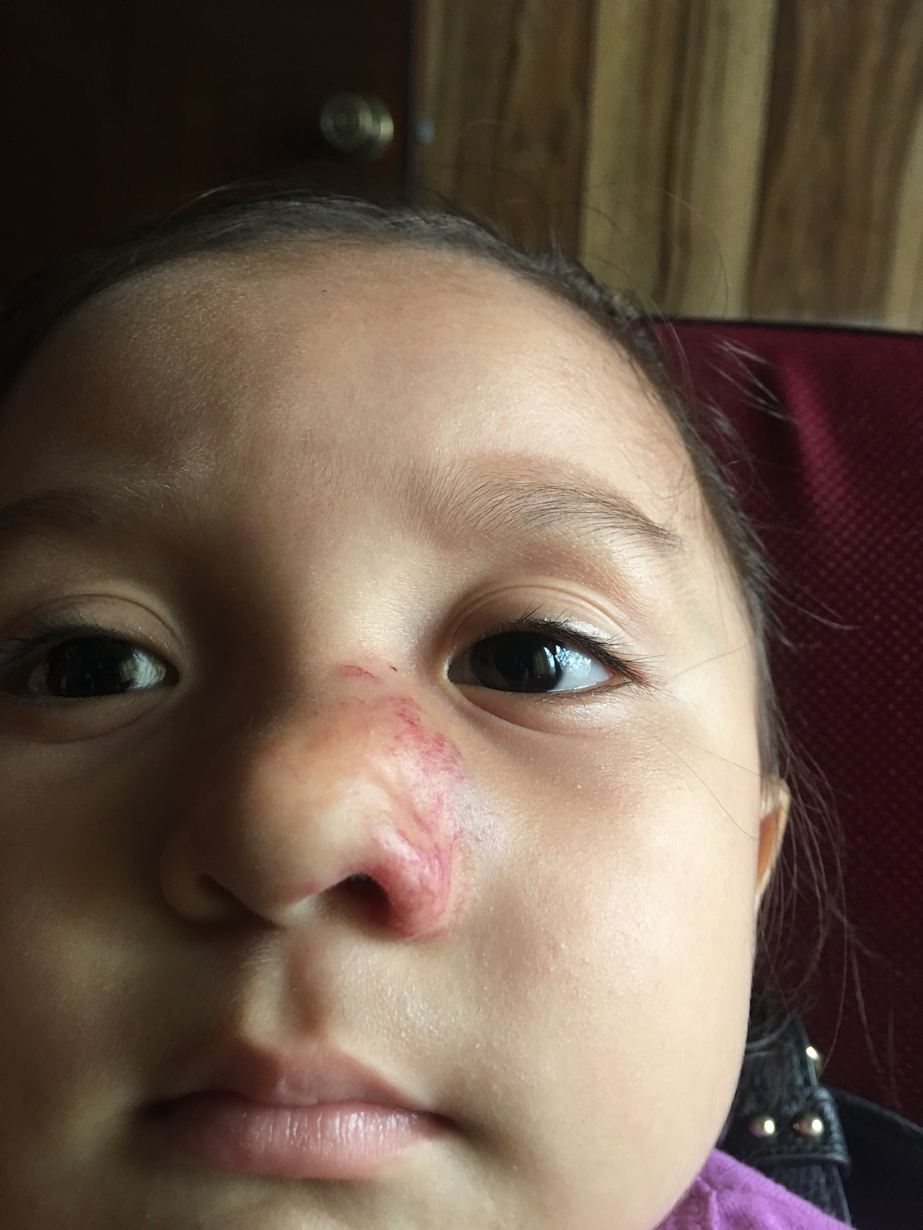 HEMANGIOMA FRESA - Imiquimod