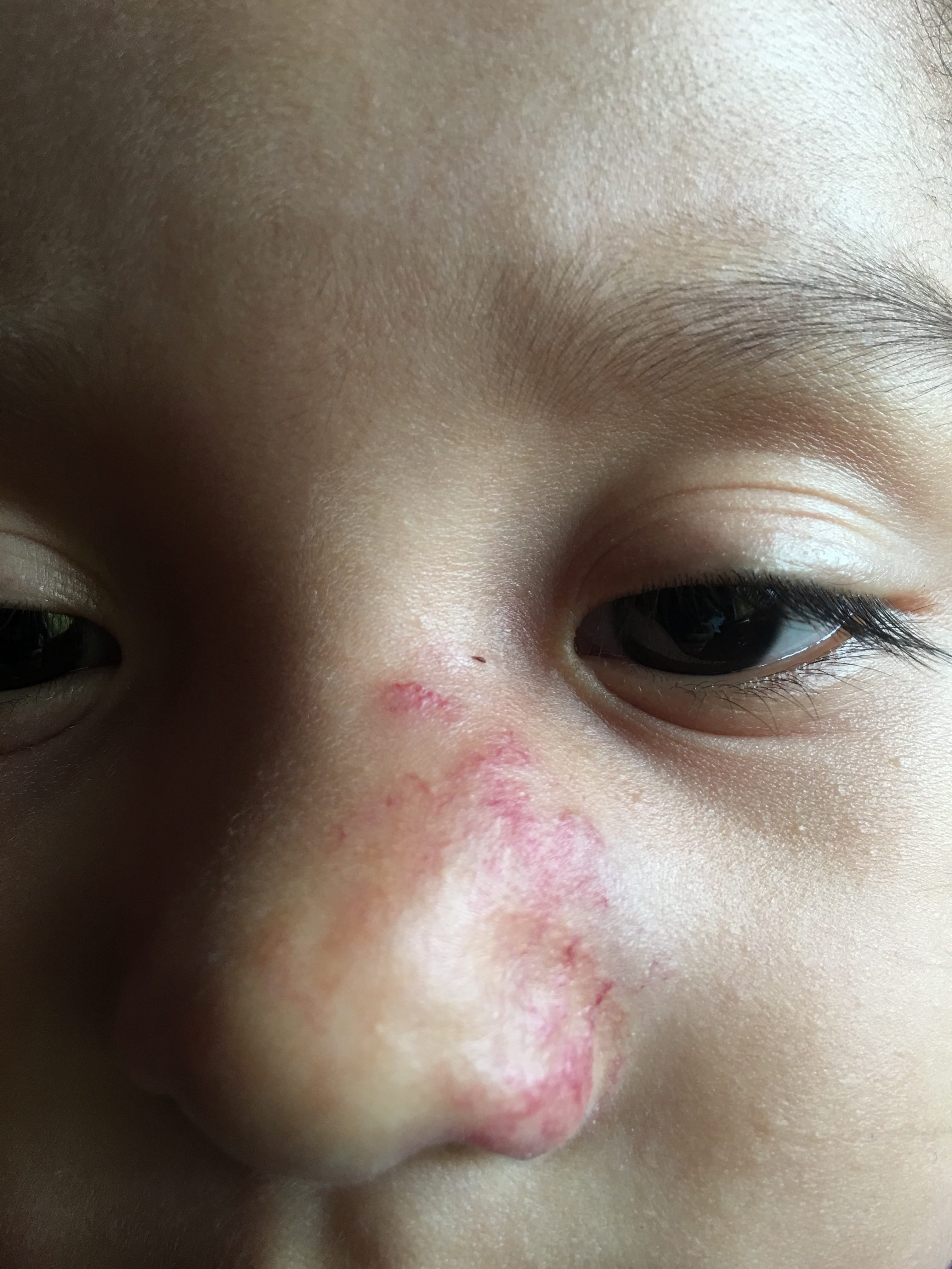 HEMANGIOMA FRESA - Imiquimod