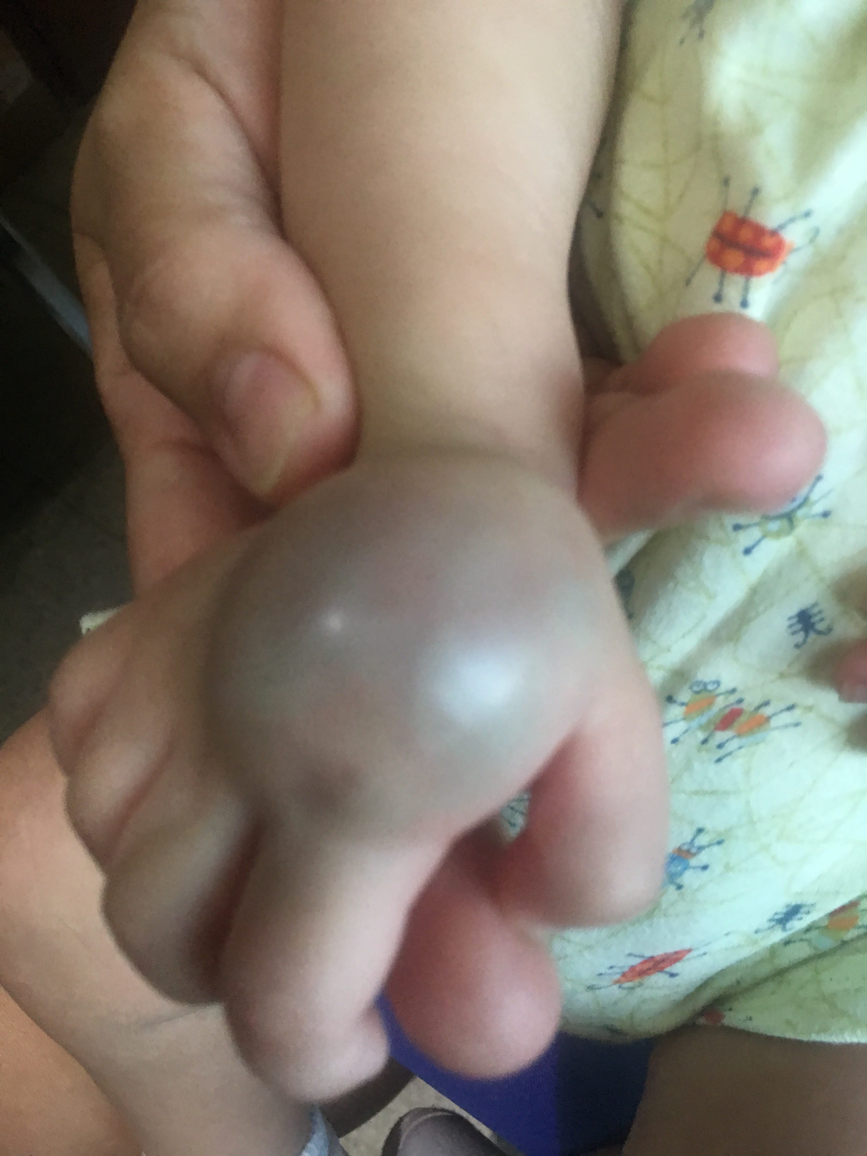 HEMANGIOMA CAVERNOSO