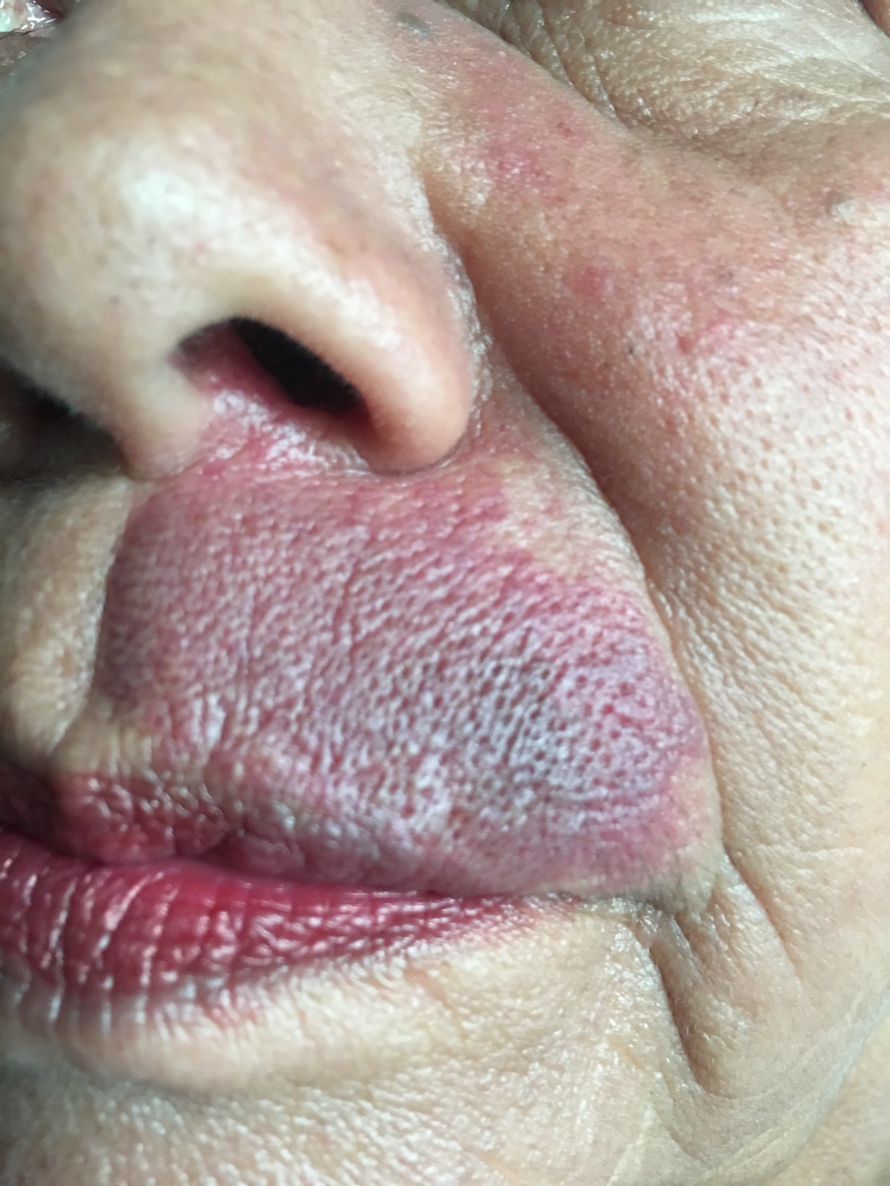 HEMANGIOMA PLANO en cara