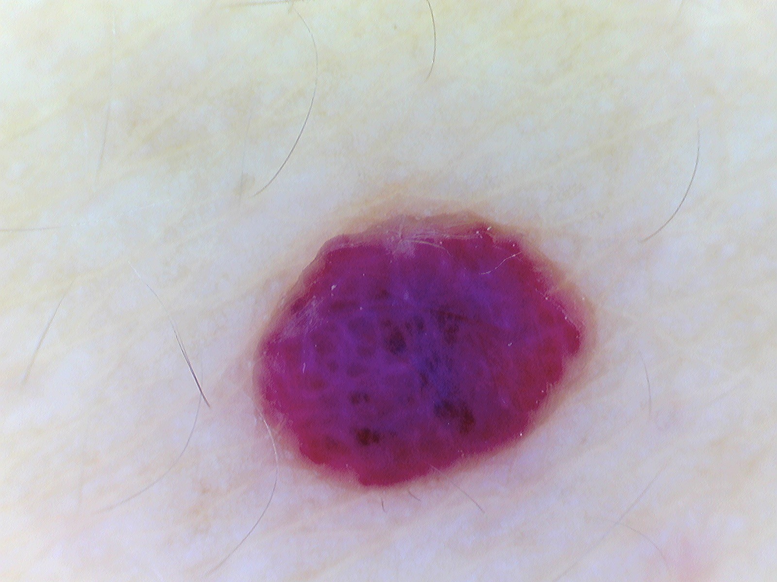 HEMANGIOMA RUBI
