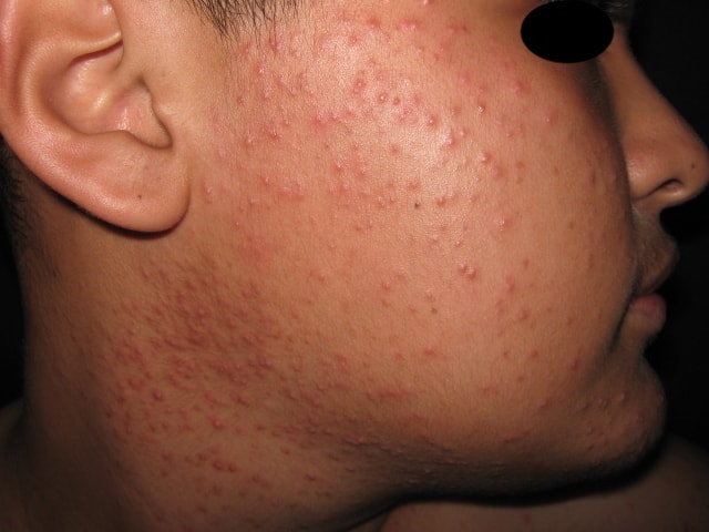 DERMATITIS ACNEIFORME
