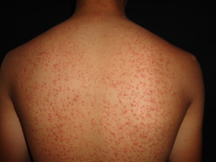 DERMATITIS ACNEIFORME