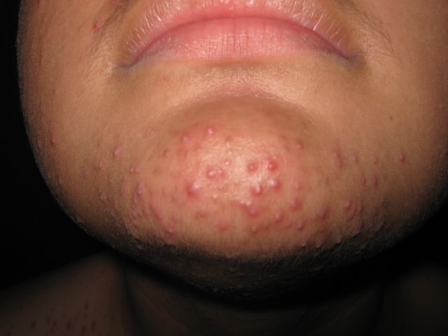 DERMATITIS ACNEIFORME