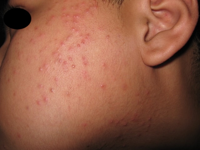 DERMATITIS ACNEIFORME