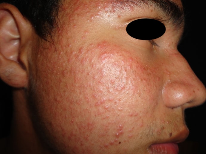 DERMATITIS ACNEIFORME