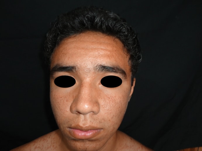 DERMATITIS ACNEIFORME