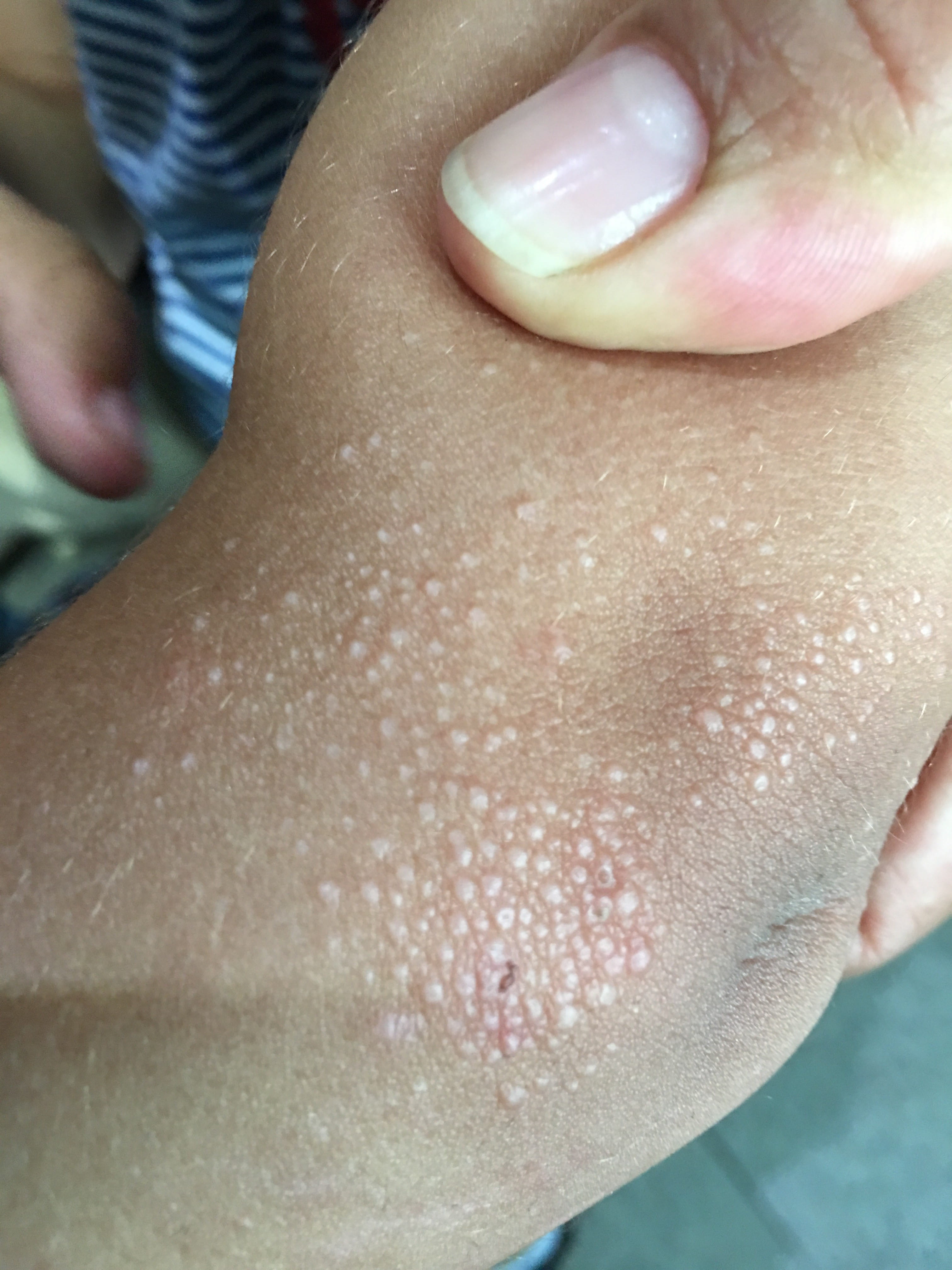 GRANULOMA ANULAR Miliar