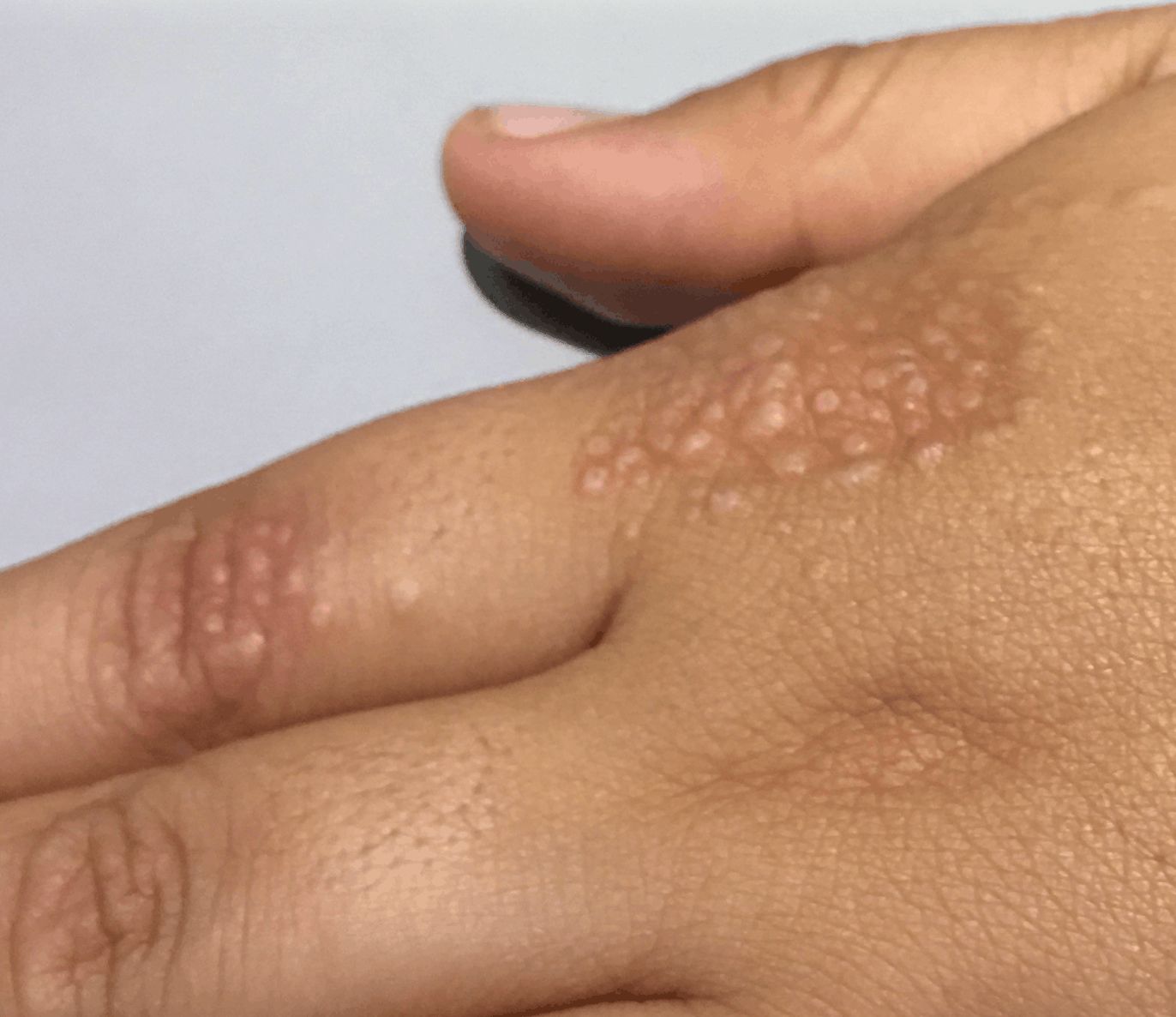 GRANULOMA ANULAR Miliar