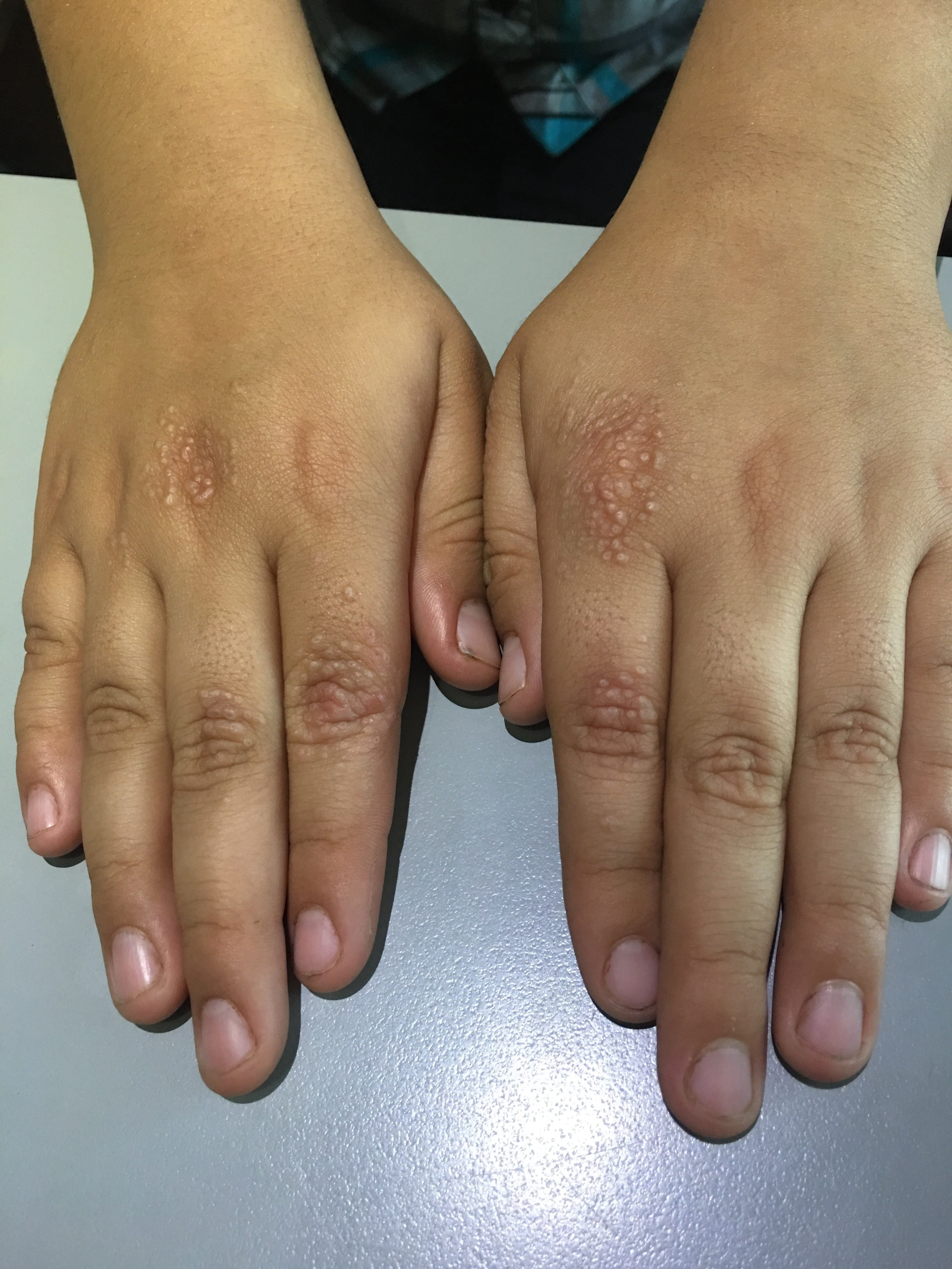 GRANULOMA ANULAR Miliar
