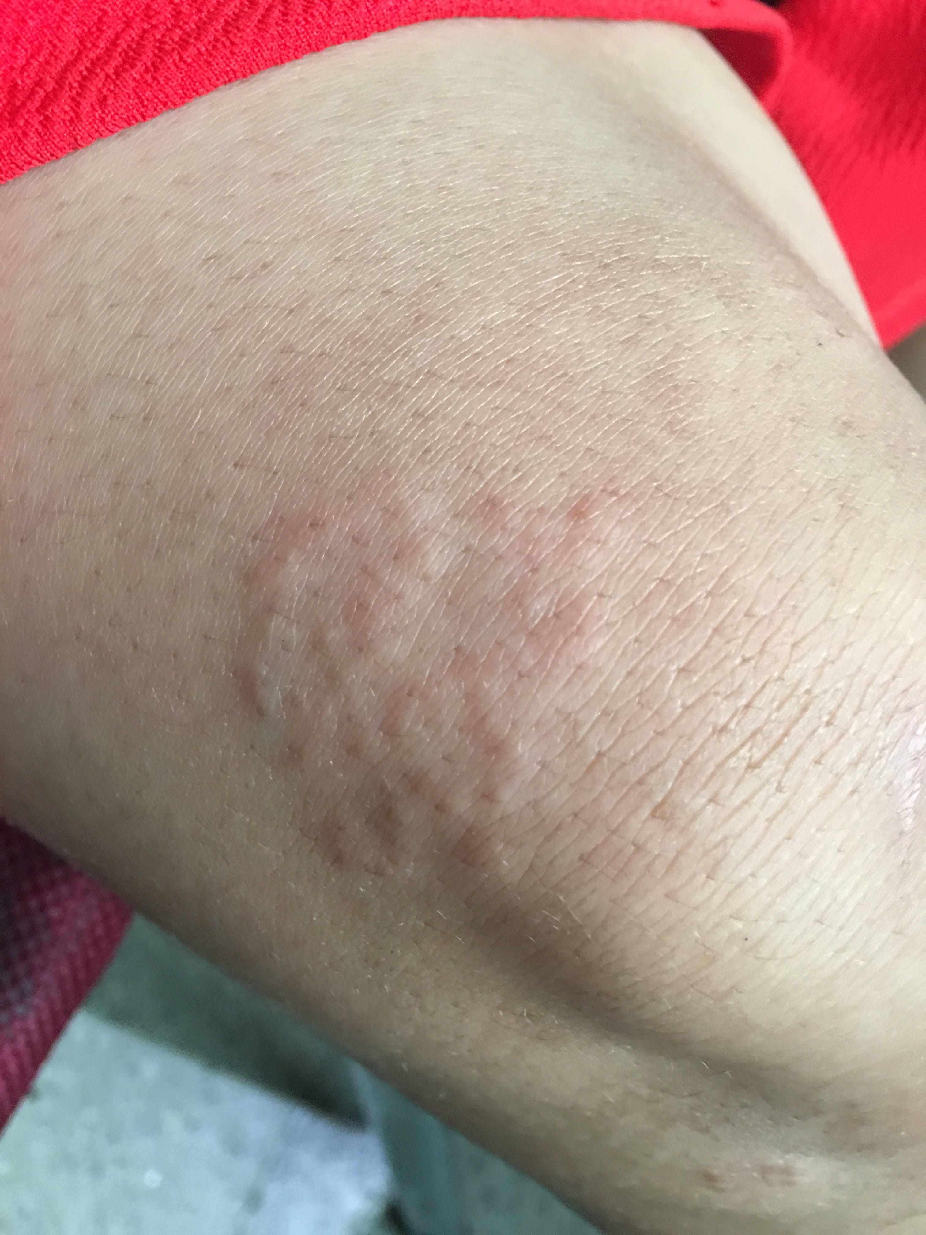 GRANULOMA ANULAR